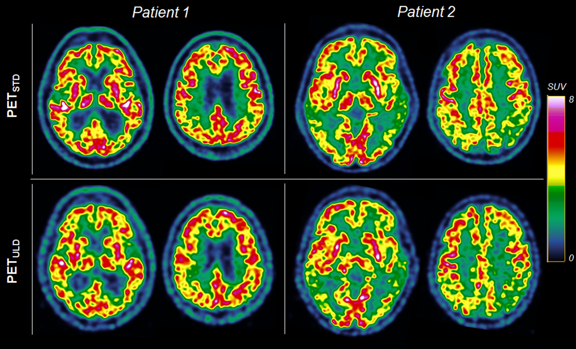 brain 18F-FDG PET/MRI in clinical settings Scientific Reports