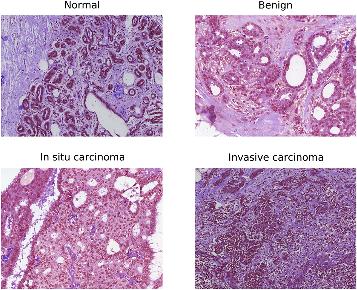 Multiclass classification of breast cancer histopathology images using  multilevel features of deep convolutional neural network