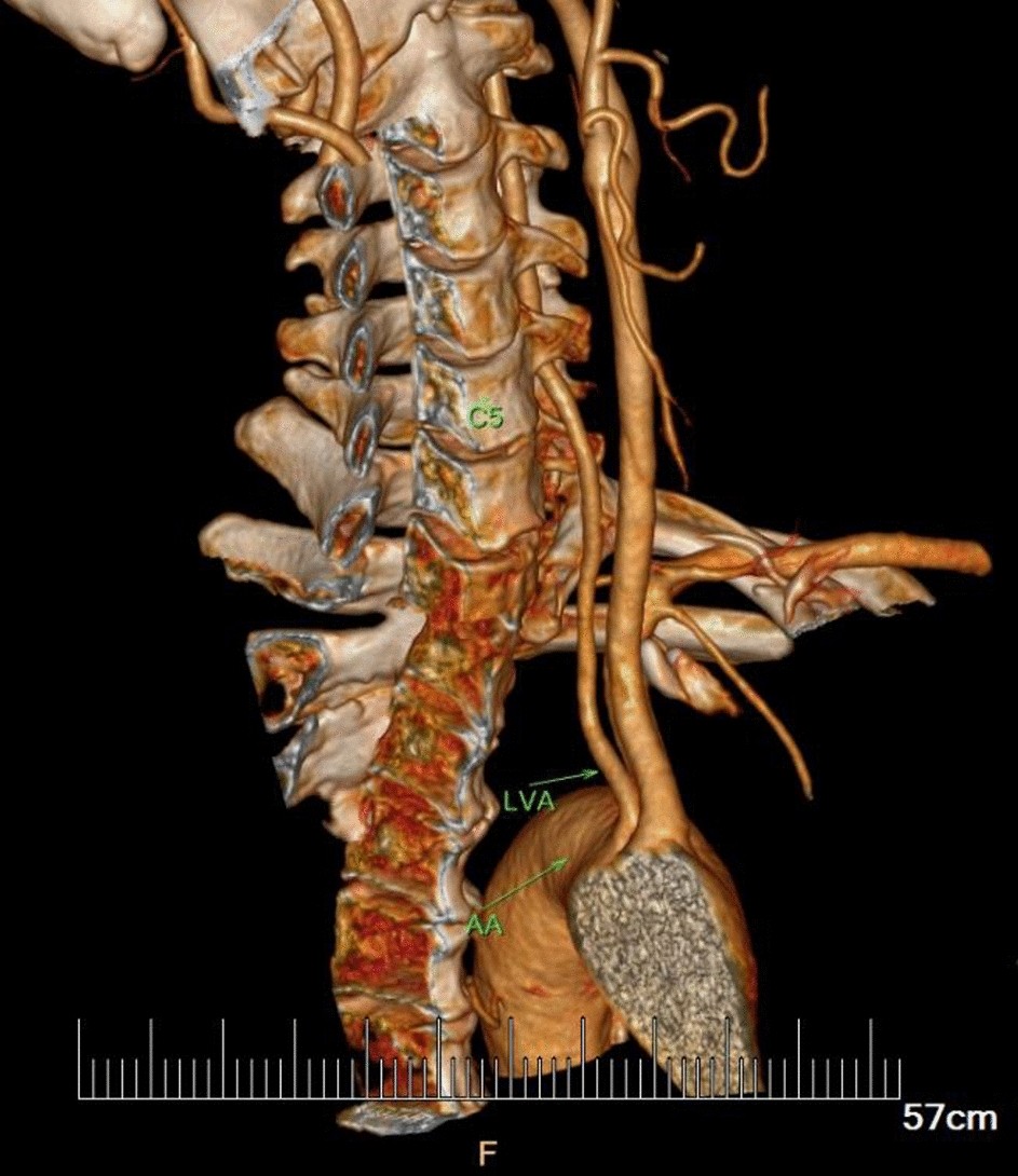 vertebral artery