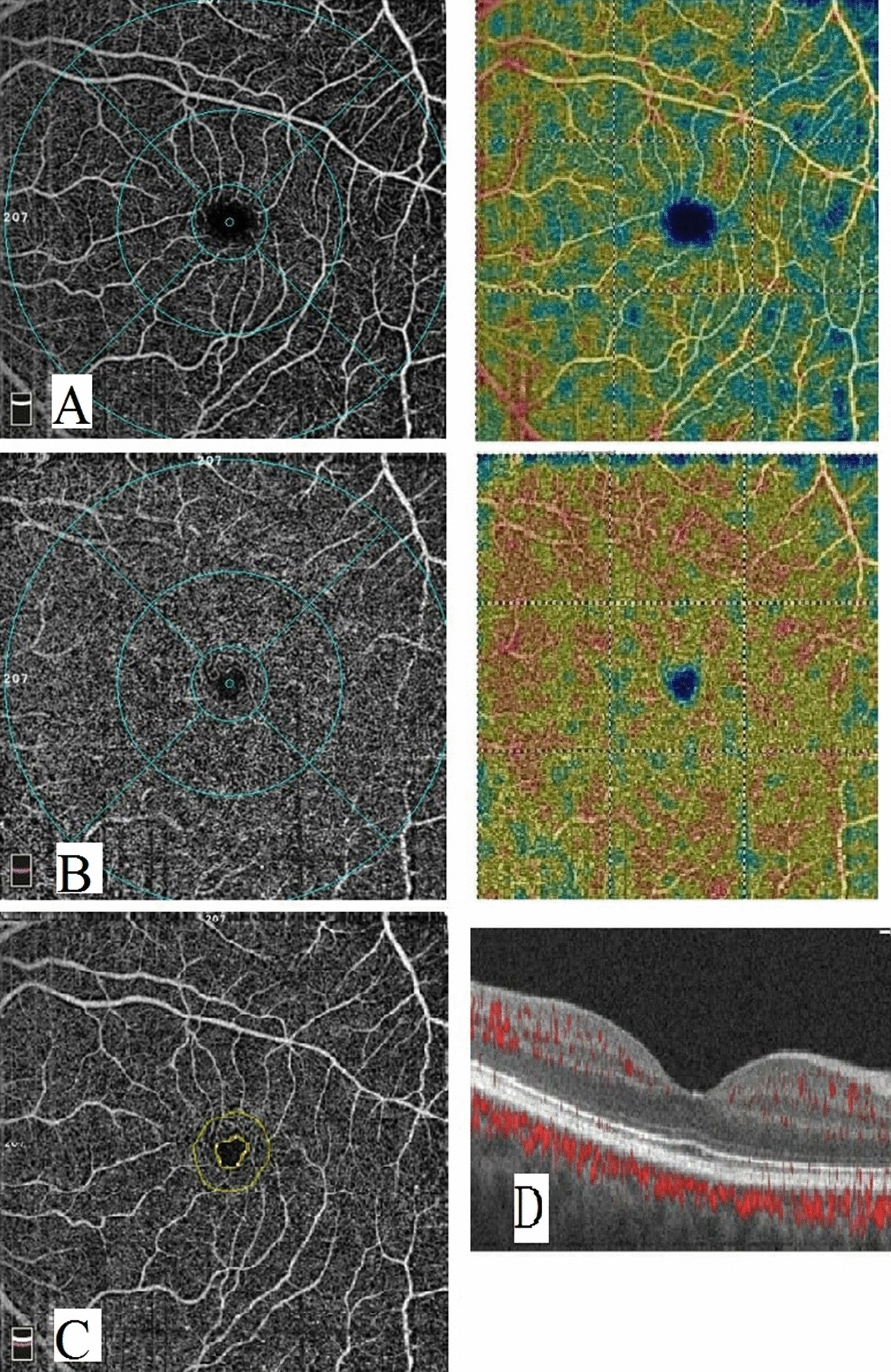 Retinal vascular assessment in psoriatic patients with and without  metabolic syndrome using optical coherence tomography angiography