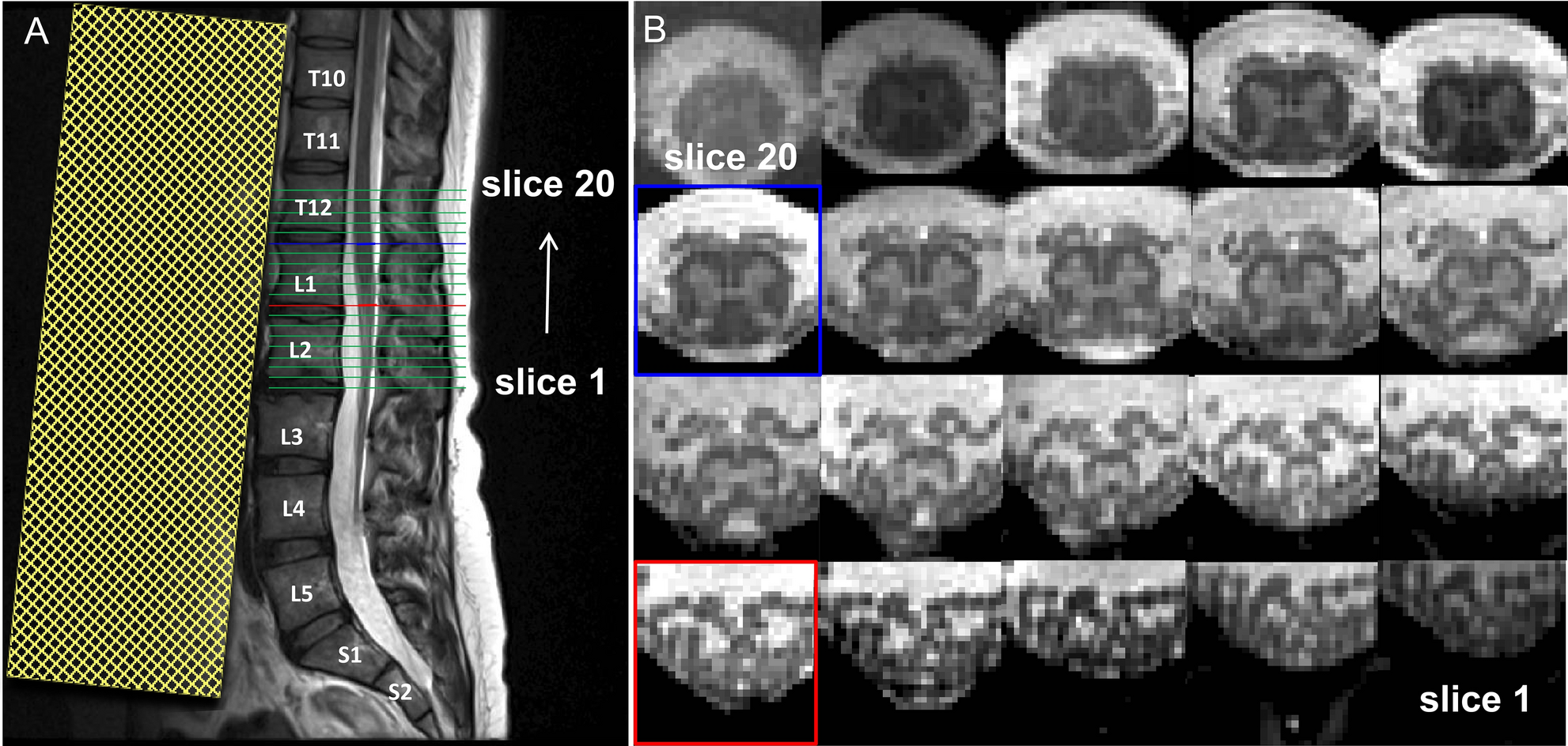 fordel Behandle Kejserlig Optimized multi-echo gradient-echo magnetic resonance imaging for gray and  white matter segmentation in the lumbosacral cord at 3 T | Scientific  Reports