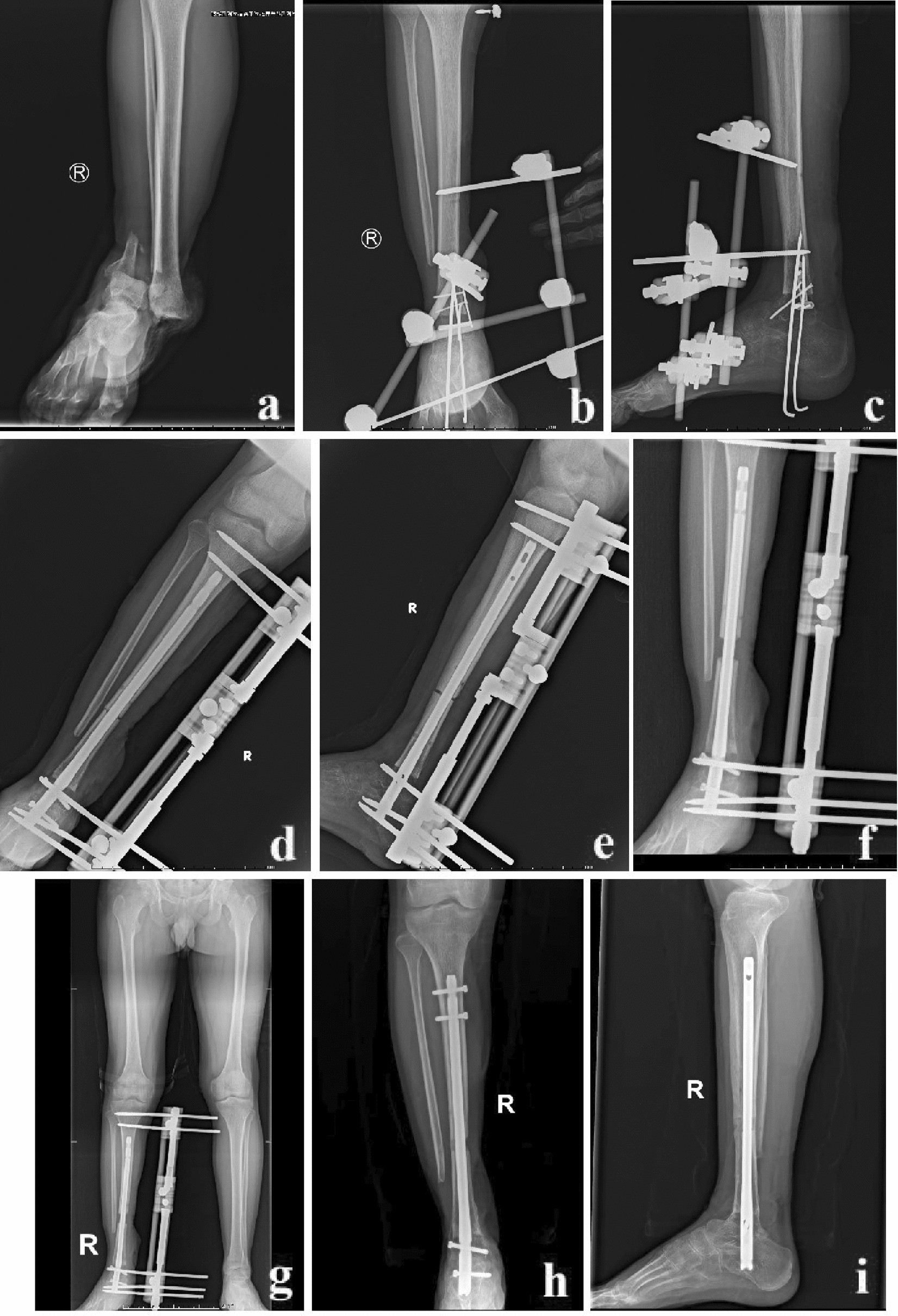 Shortening and re-lengthening versus bone transport for the treatment of  distal tibial periarticular post-traumatic defects | Scientific Reports