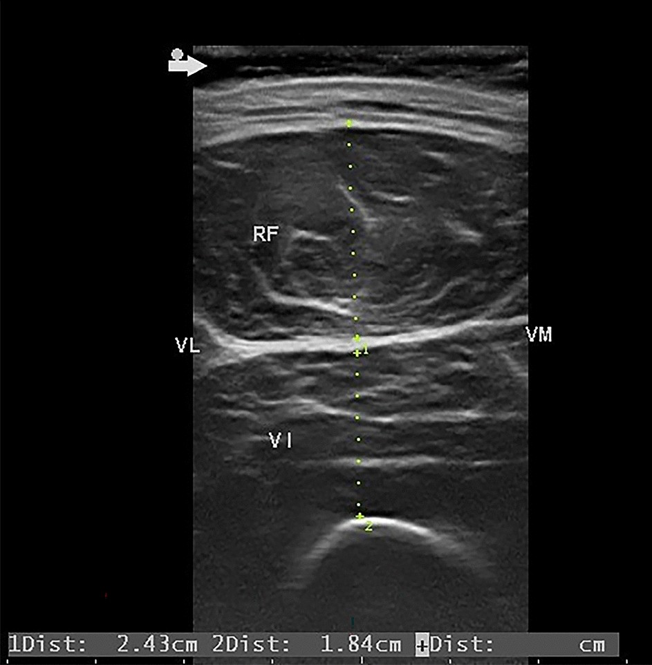 Investigating the rate of skeletal muscle atrophy in men and women in the intensive care unit a prospective observational study Scientific Reports picture