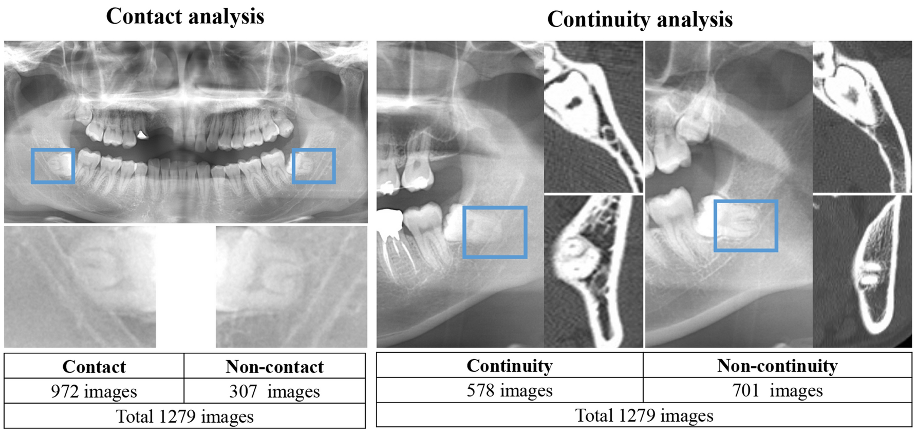 Inferior alveolar nerve, Radiology Reference Article