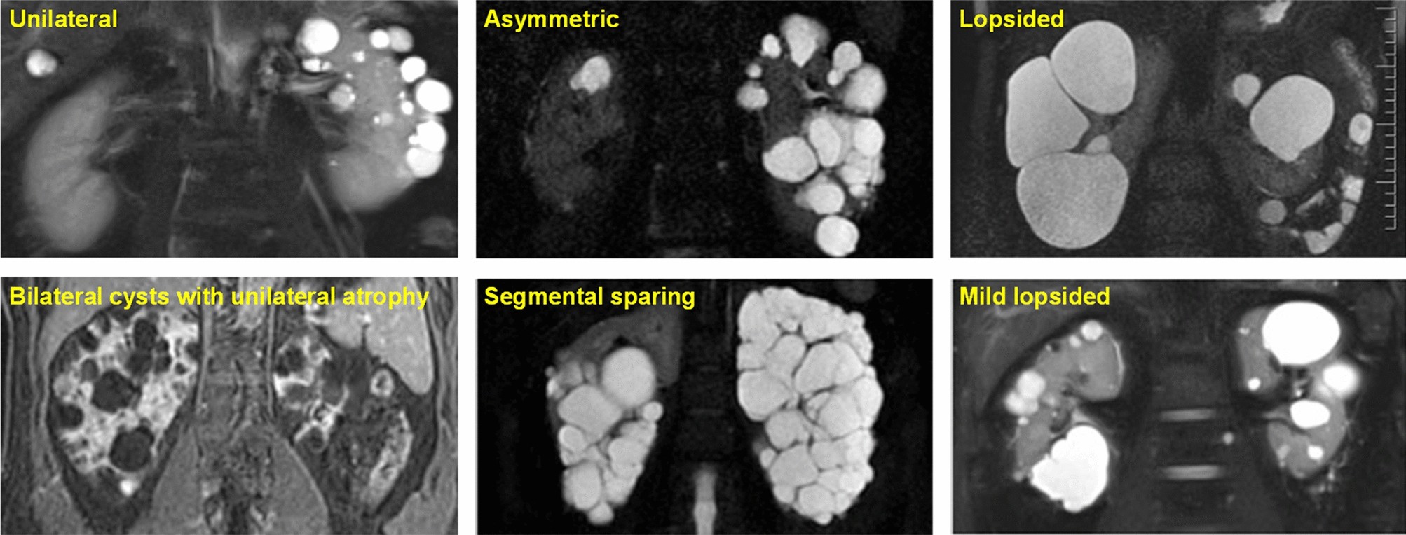 Atypical Polycystic Kidney Disease as defined by Imaging | Scientific  Reports