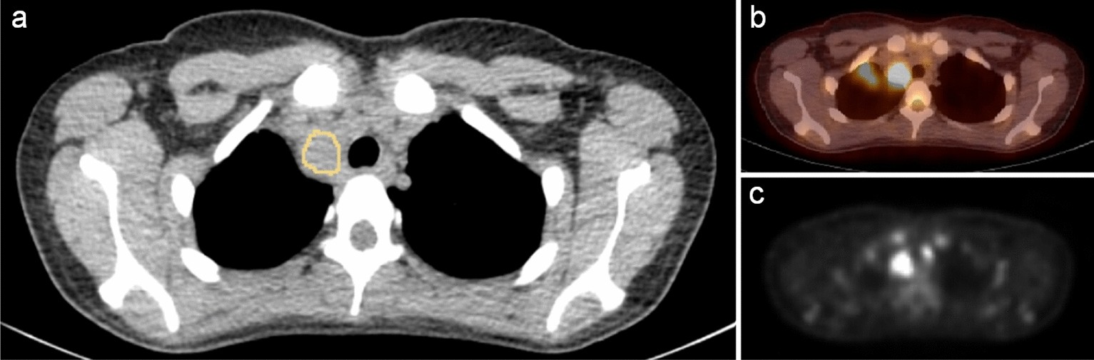 NEXUS score vs CT scan findings.