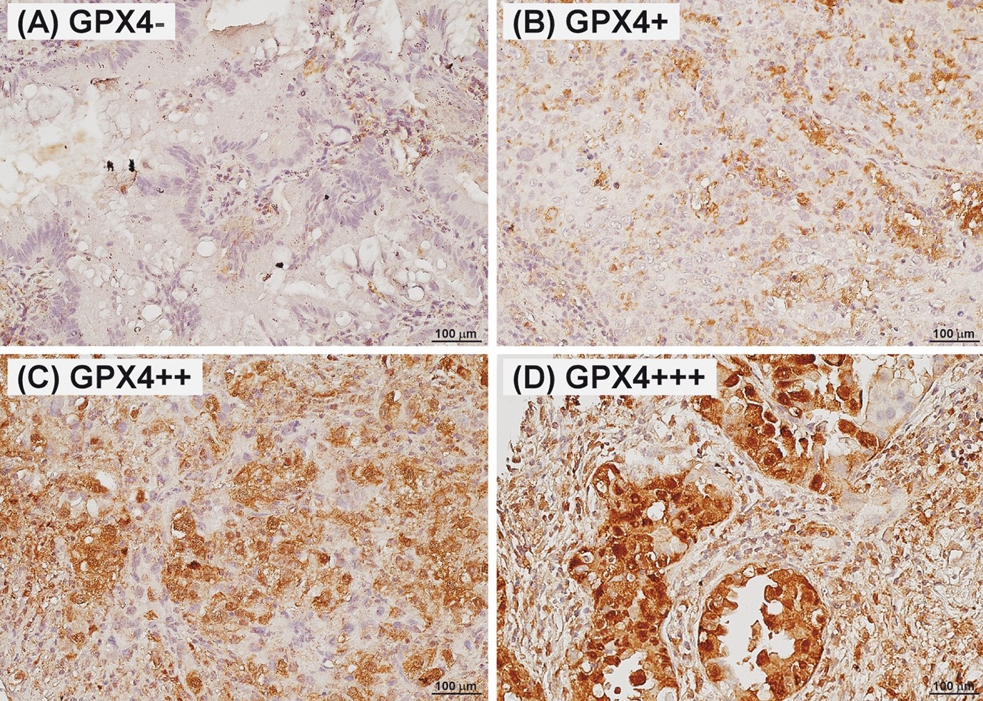 Glutathione peroxidase 4 expression predicts poor overall survival in  patients with resected lung adenocarcinoma | Scientific Reports