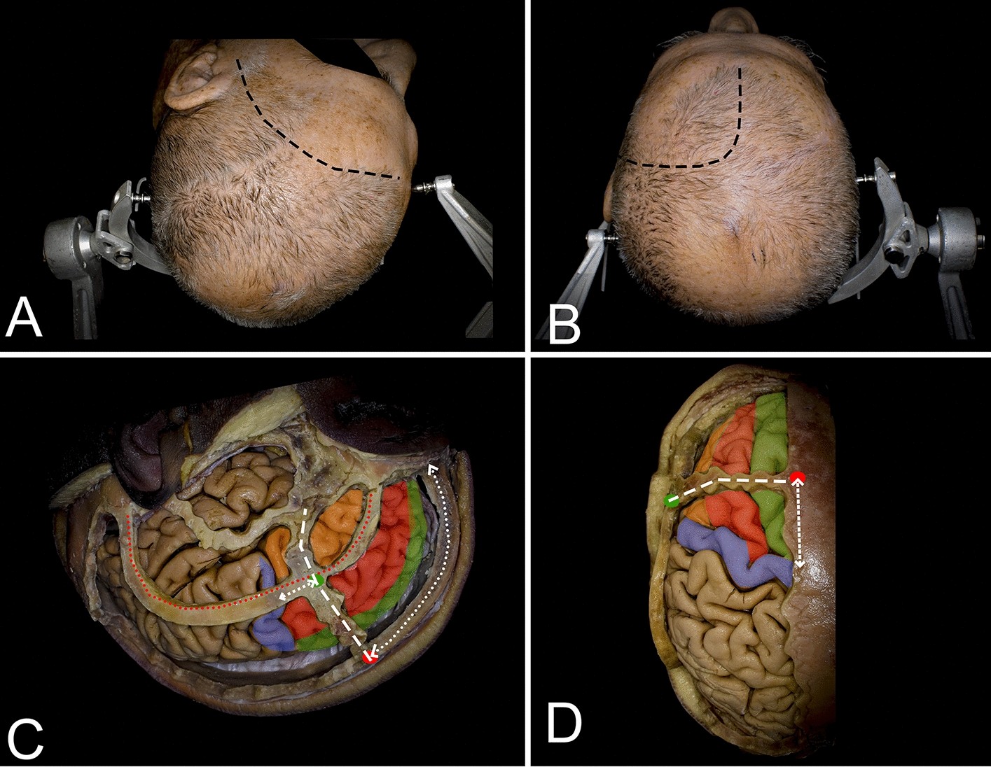 Figure 1 from Brain surface temperature under a craniotomy.