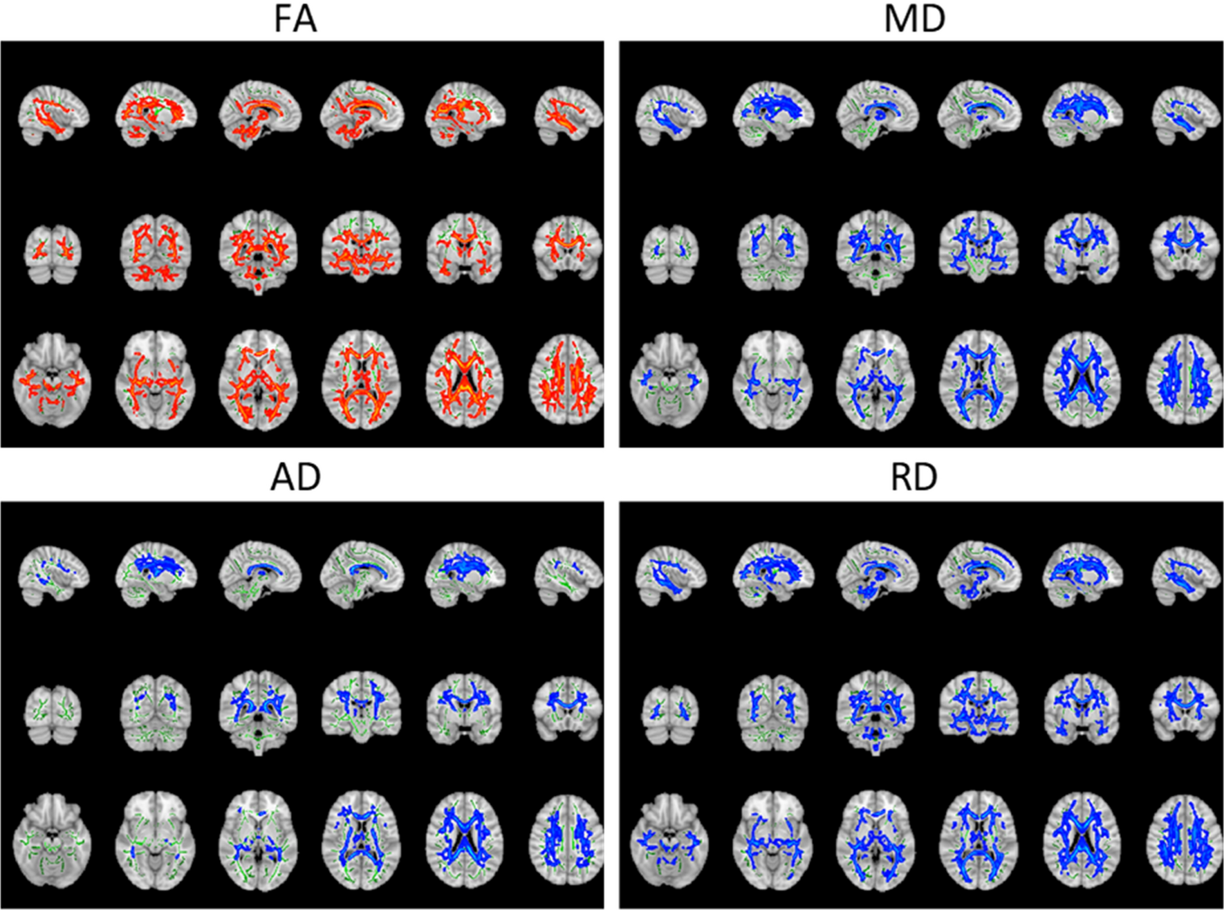 Radial diffusivity reflects general decline rather than specific cognitive  deterioration in multiple sclerosis | Scientific Reports