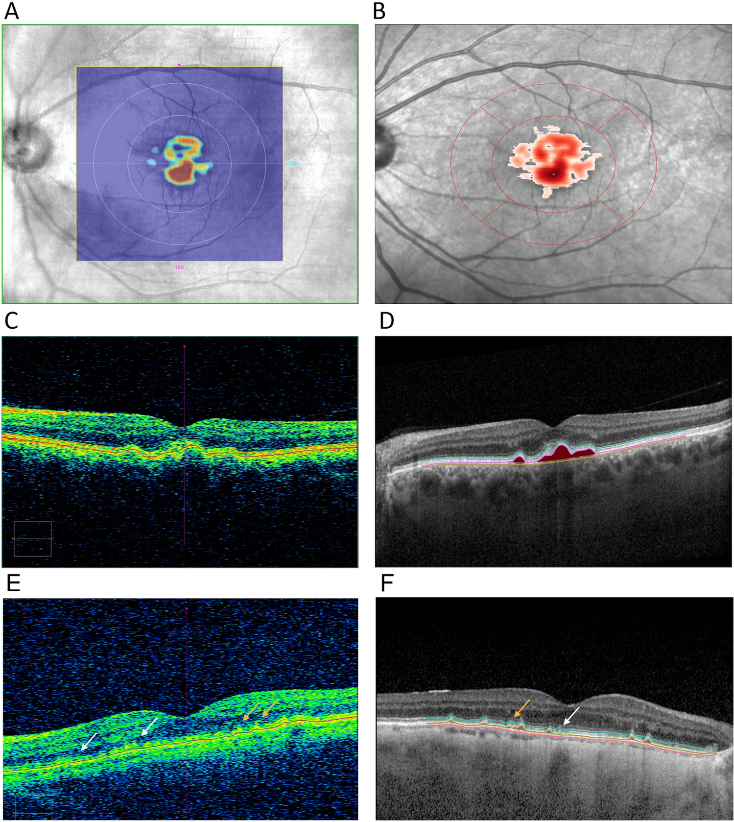 Comparability of automated drusen volume measurements in age-related  macular degeneration: a MACUSTAR study report | Scientific Reports
