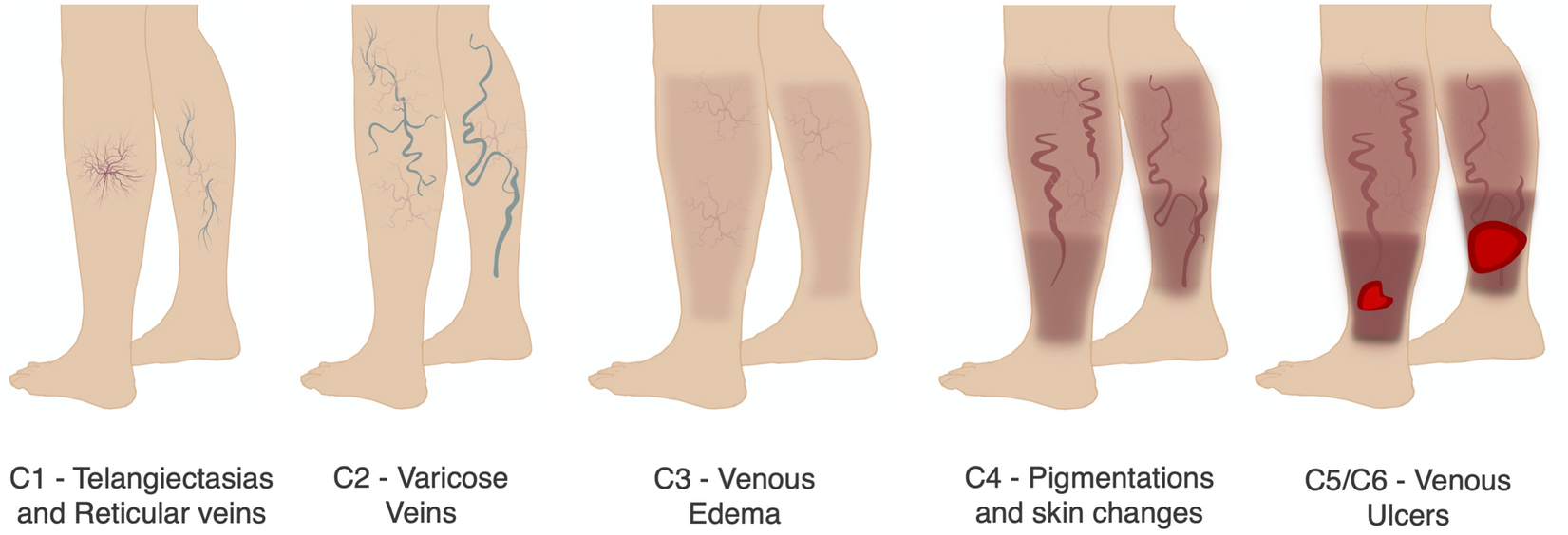 Chronic Venous Insufficiency Stages Explained