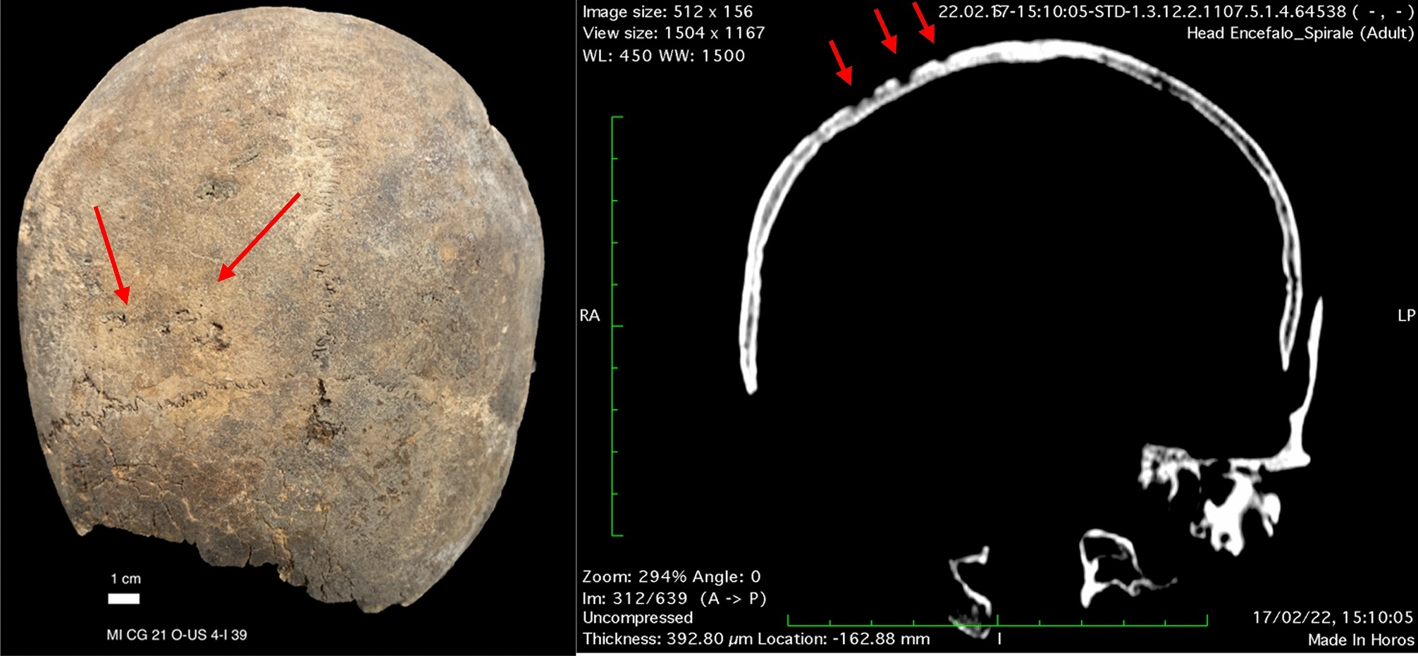 Papaver somniferum in seventeenth century (Italy): archaeotoxicological  study on brain and bone samples in patients from a hospital in Milan |  Scientific Reports