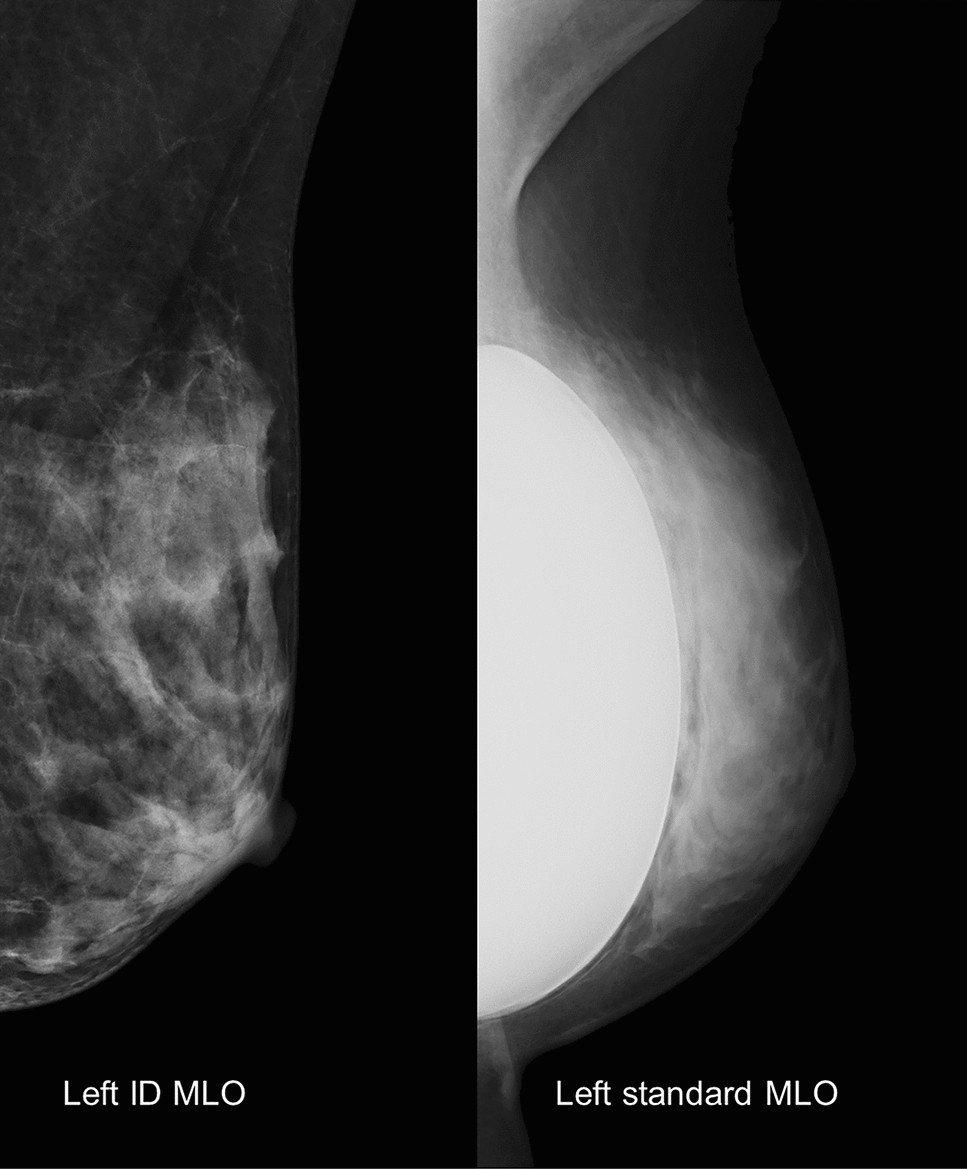 Appropriate screening mammography method for patients with breast implants