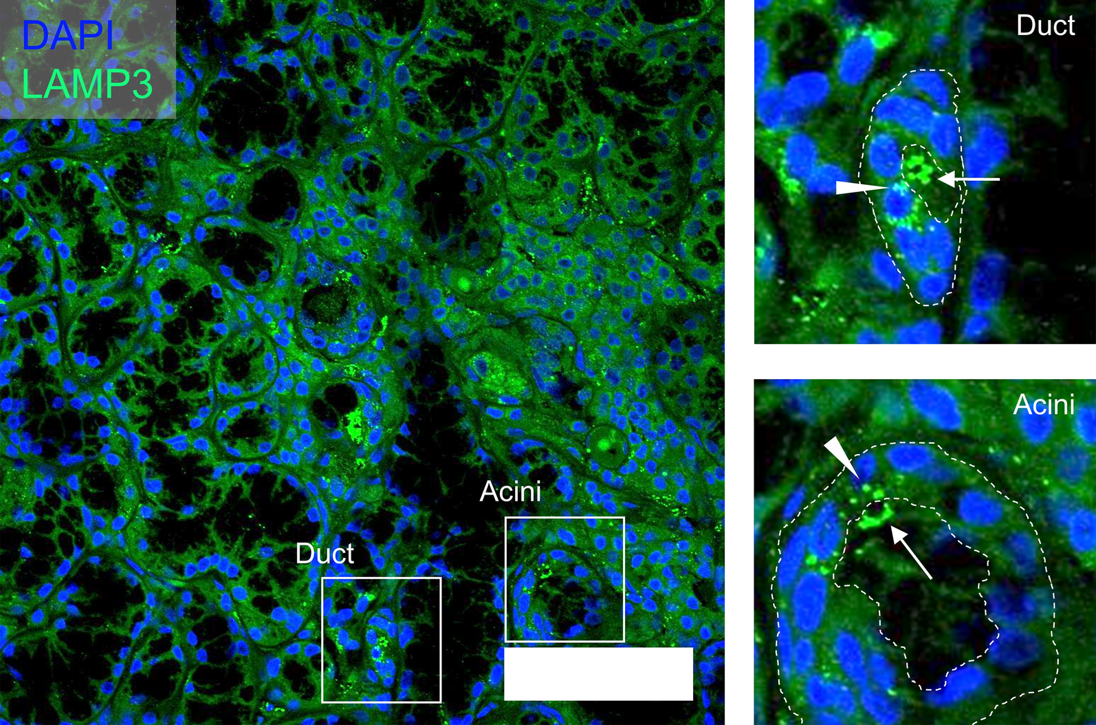 LAMP3 transfer via extracellular particles induces apoptosis in Sjögren's  disease | Scientific Reports