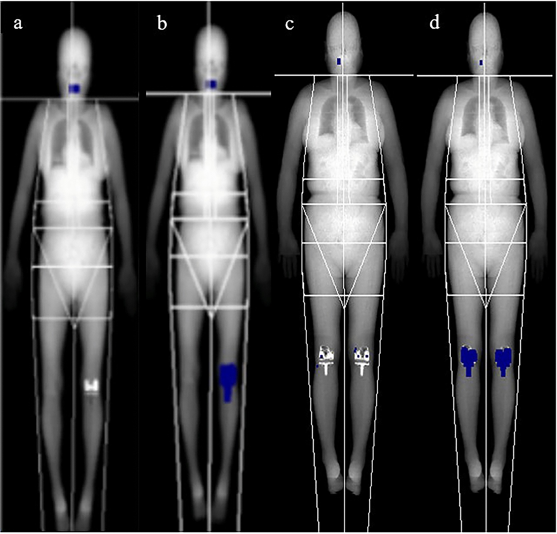 Effect of total knee replacement on skeletal muscle mass measurements using dual energy X-ray absorptiometry Scientific Reports photo