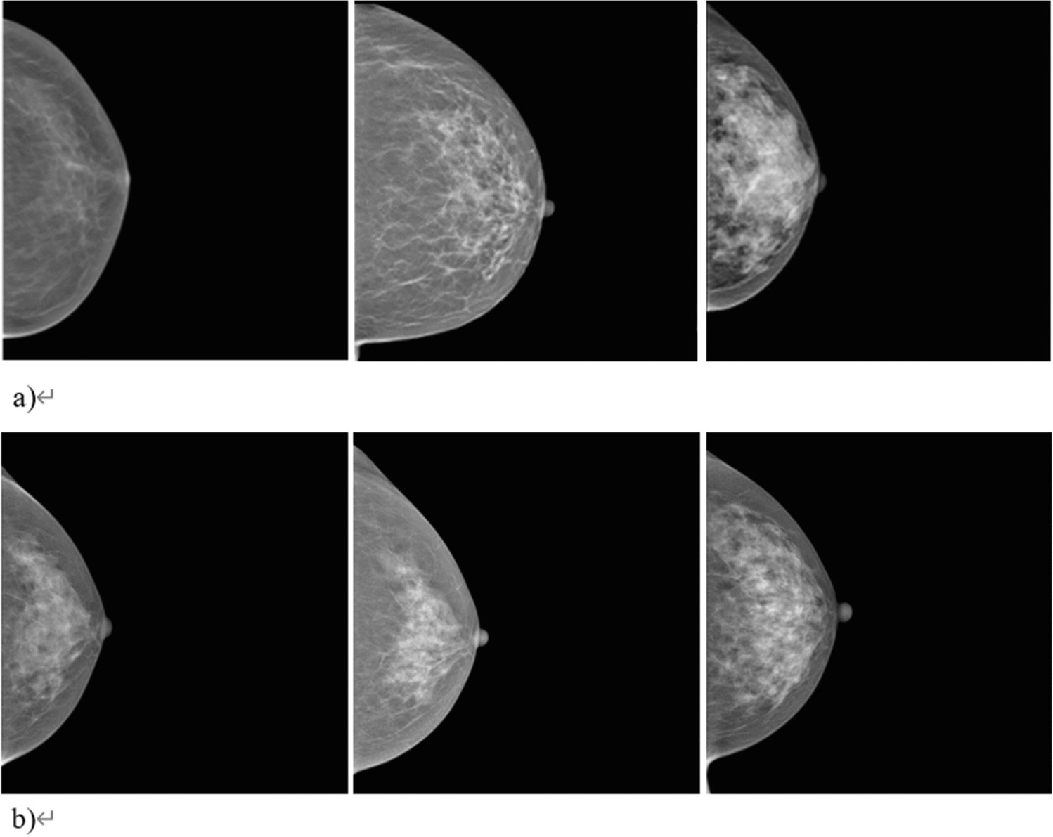 Unsupervised anomaly detection with generative adversarial networks in  mammography