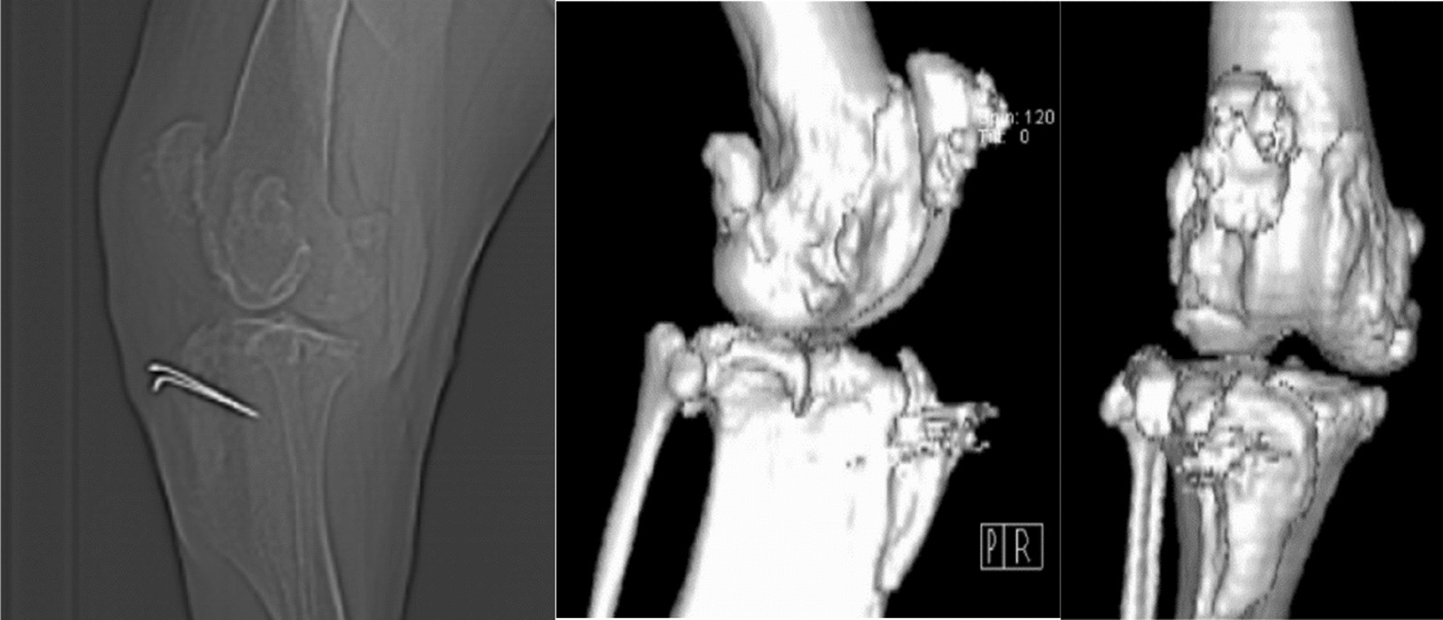 Plate osteosynthesis combined with bone cement provides the