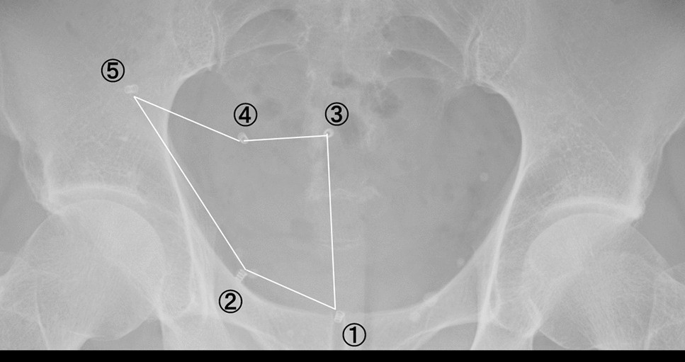 Retroperitoneal totally endoscopic prosthetic repair of lumbar