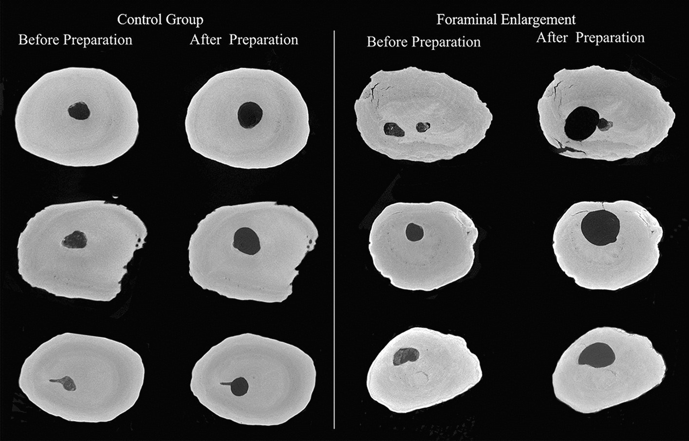 Effect of foraminal enlargement on microcrack formation and apical  transportation: a nano-CT assessment | Scientific Reports