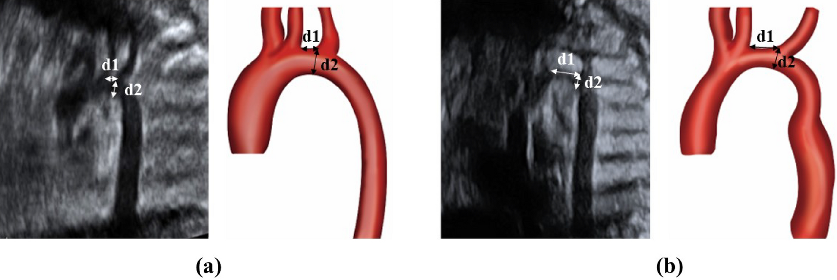 transverse arch aorta