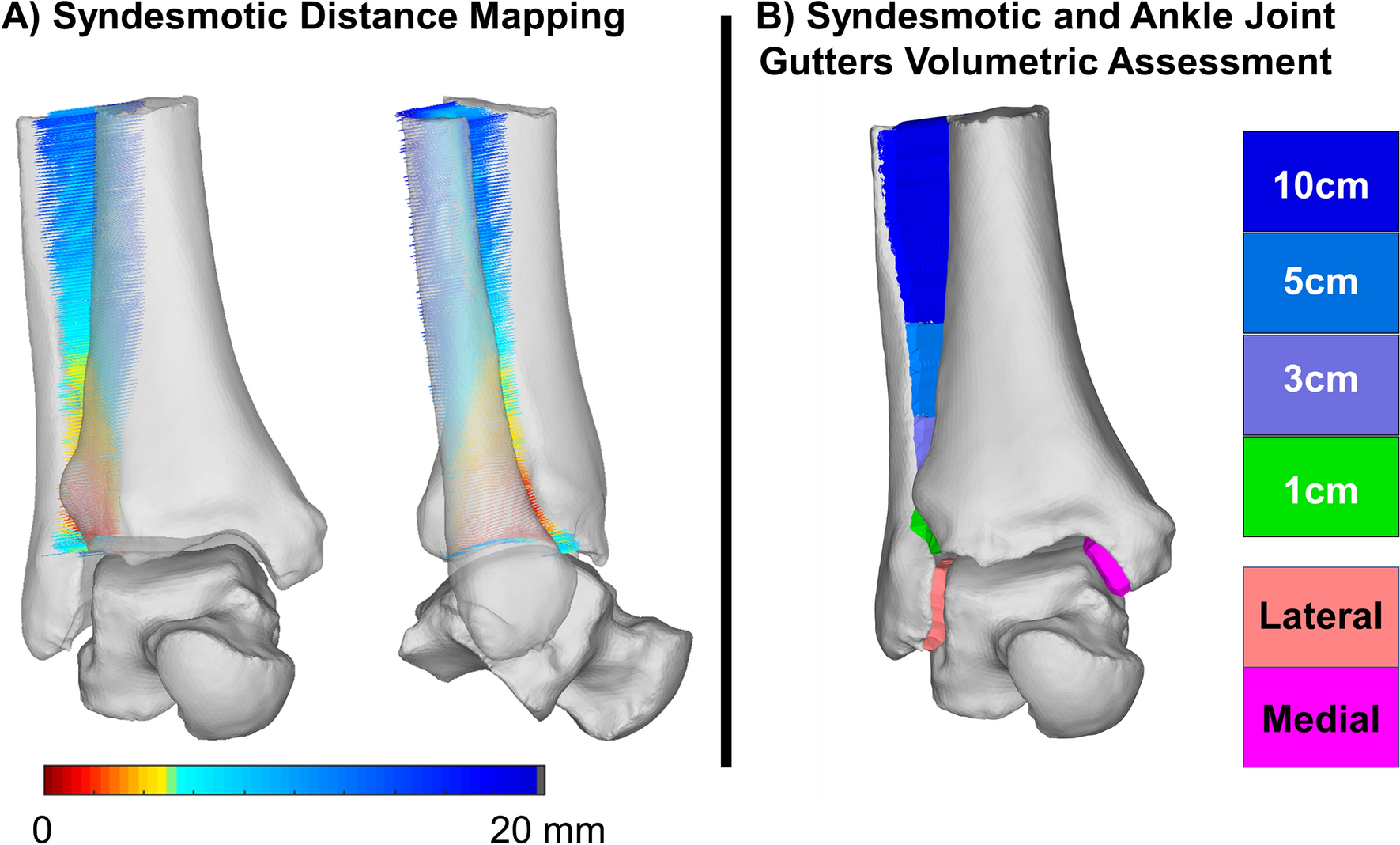 Distance mapping and volumetric assessment of the ankle and syndesmotic  joints in progressive collapsing foot deformity