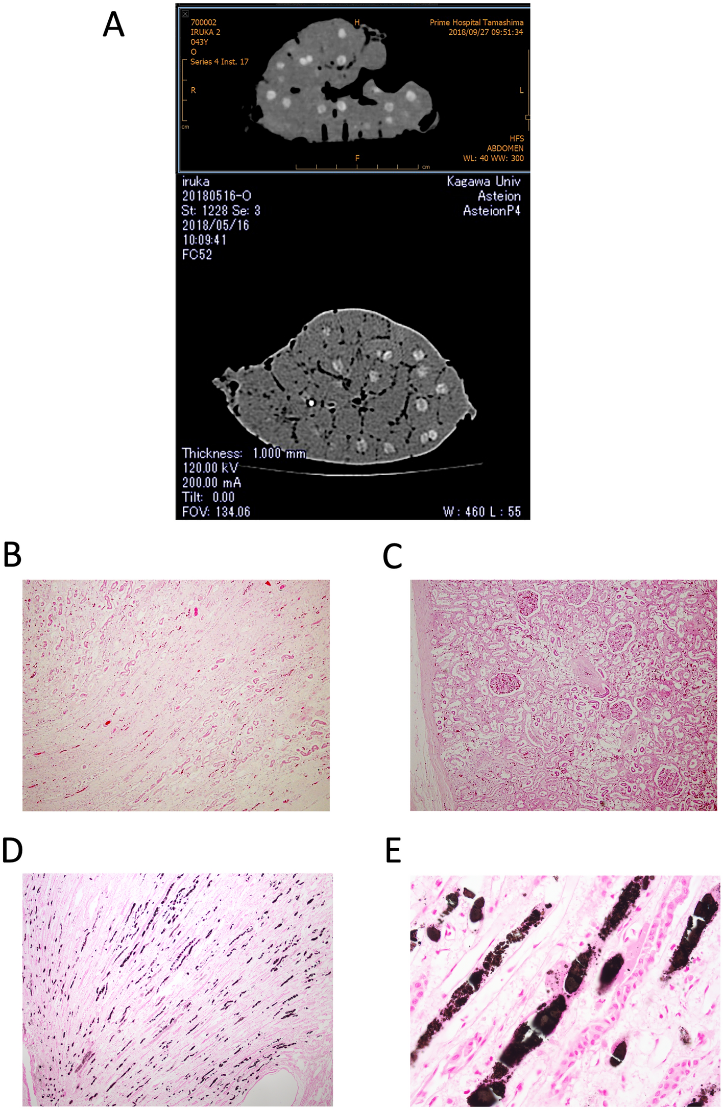 Possible contribution of phosphate to the pathogenesis of chronic 