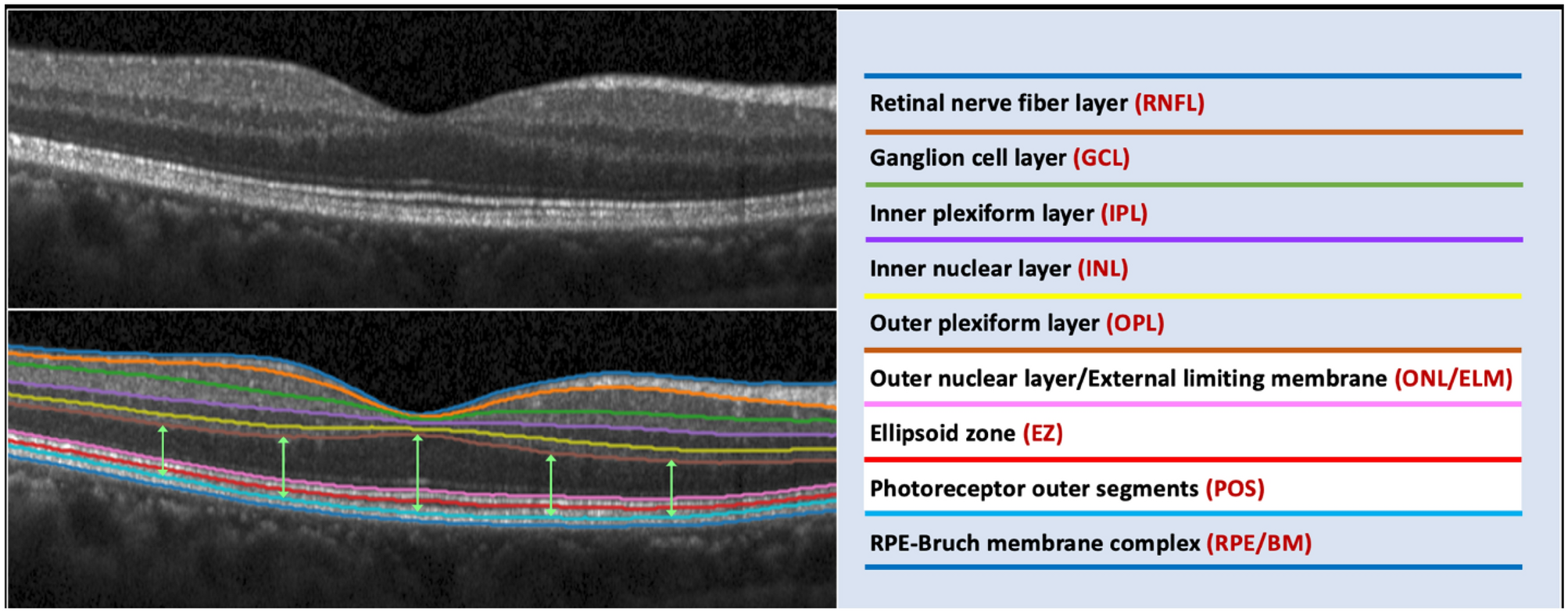 Layers of the Retina - Discovery Eye Foundation