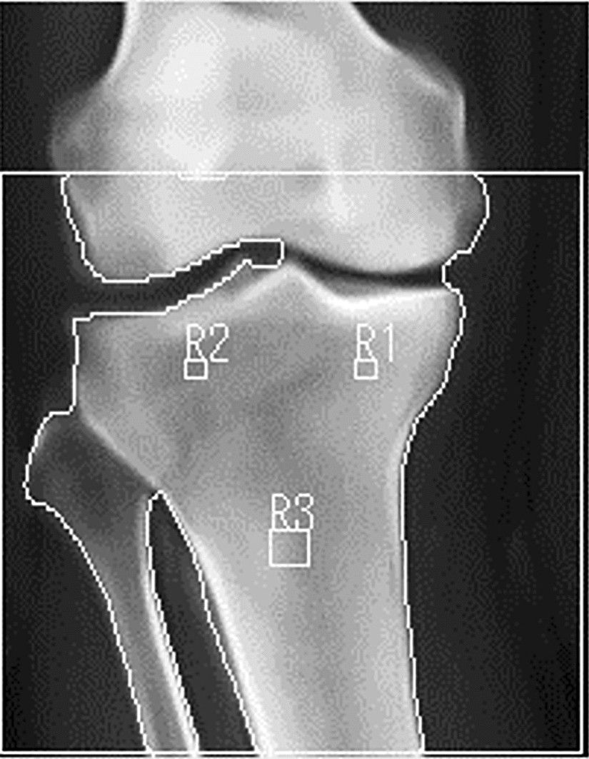 Tibial Spine Fractures  Florida Orthopaedic Institute
