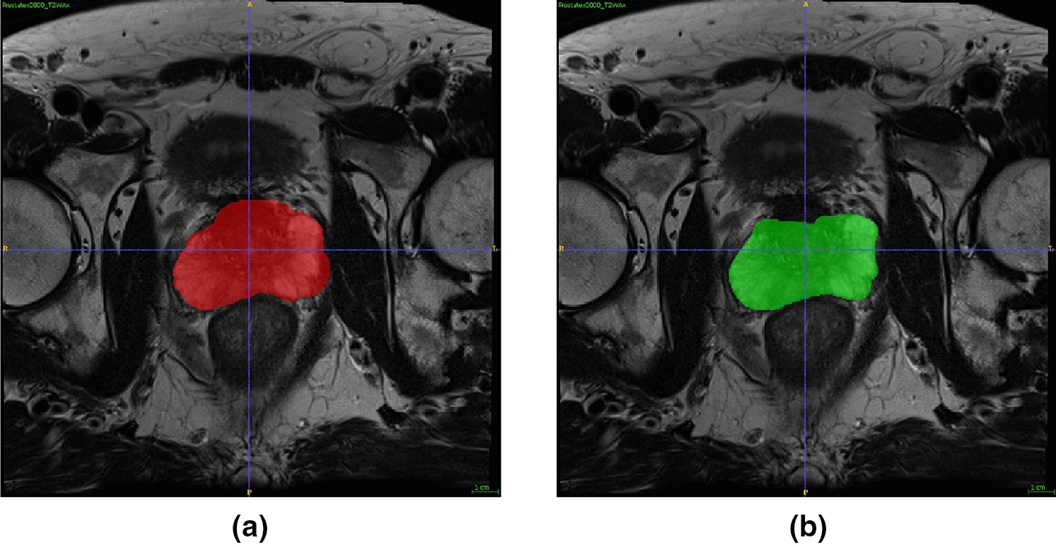 PDF) Advancements in MRI-Based Radiomics and Artificial Intelligence for  Prostate Cancer: A Comprehensive Review and Future Prospects