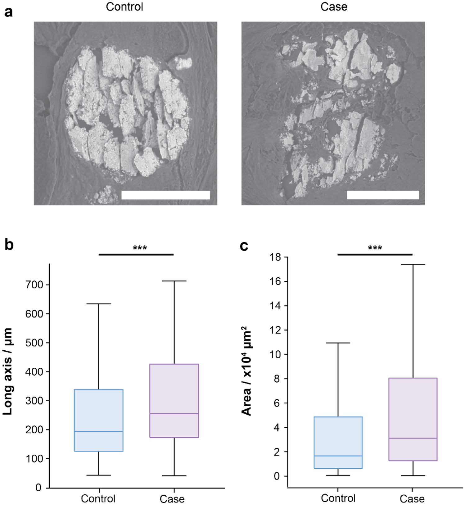 Microcalcification crystallography as a potential marker of DCIS recurrence  | Scientific Reports