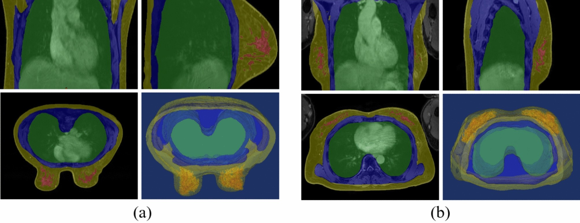 Improvement of semantic segmentation through transfer learning of  multi-class regions with convolutional neural networks on supine and prone  breast MRI images