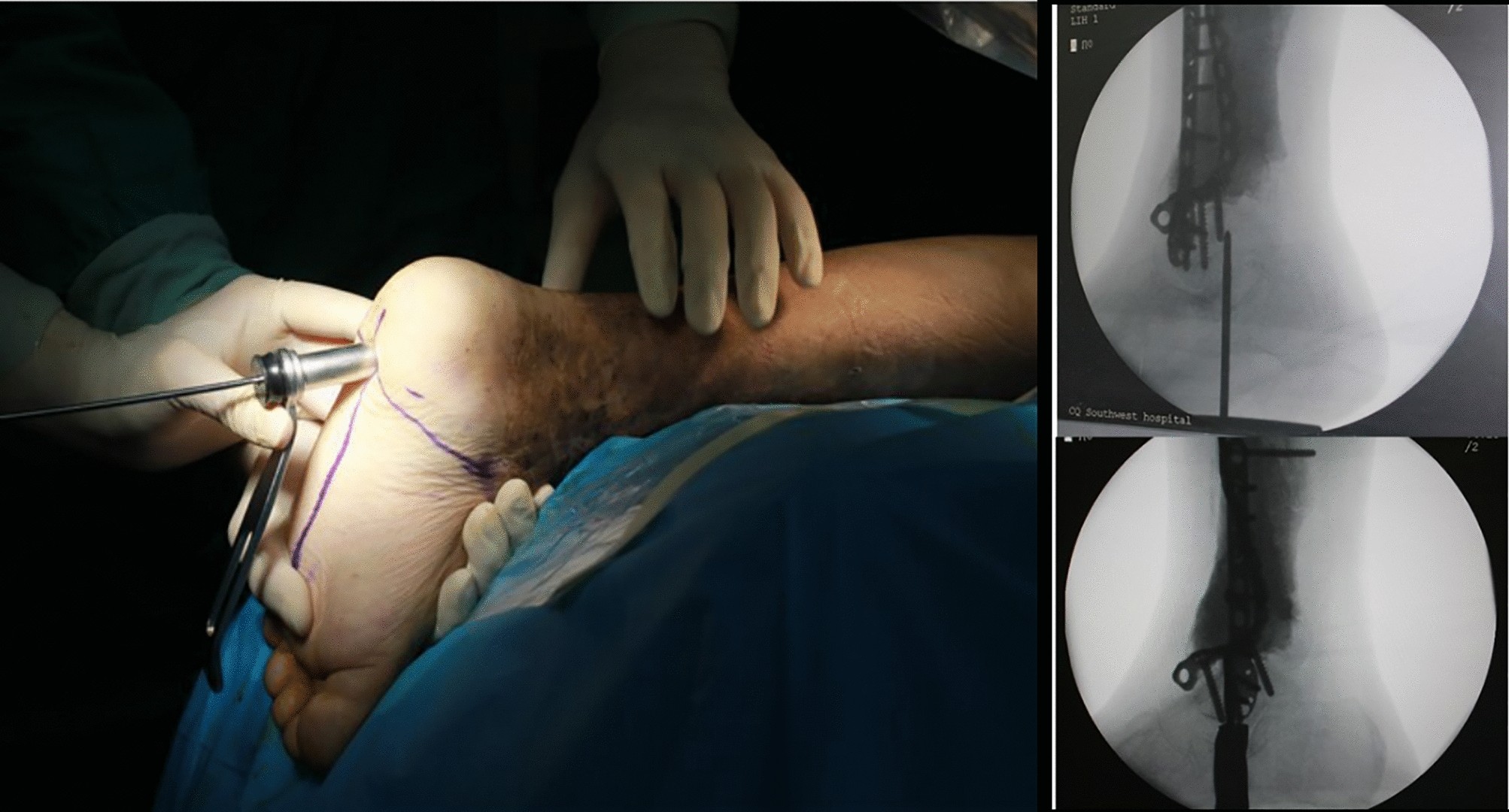 Hindfoot nail combined with limited ORIF and distal fibula transfer... |  Download Scientific Diagram