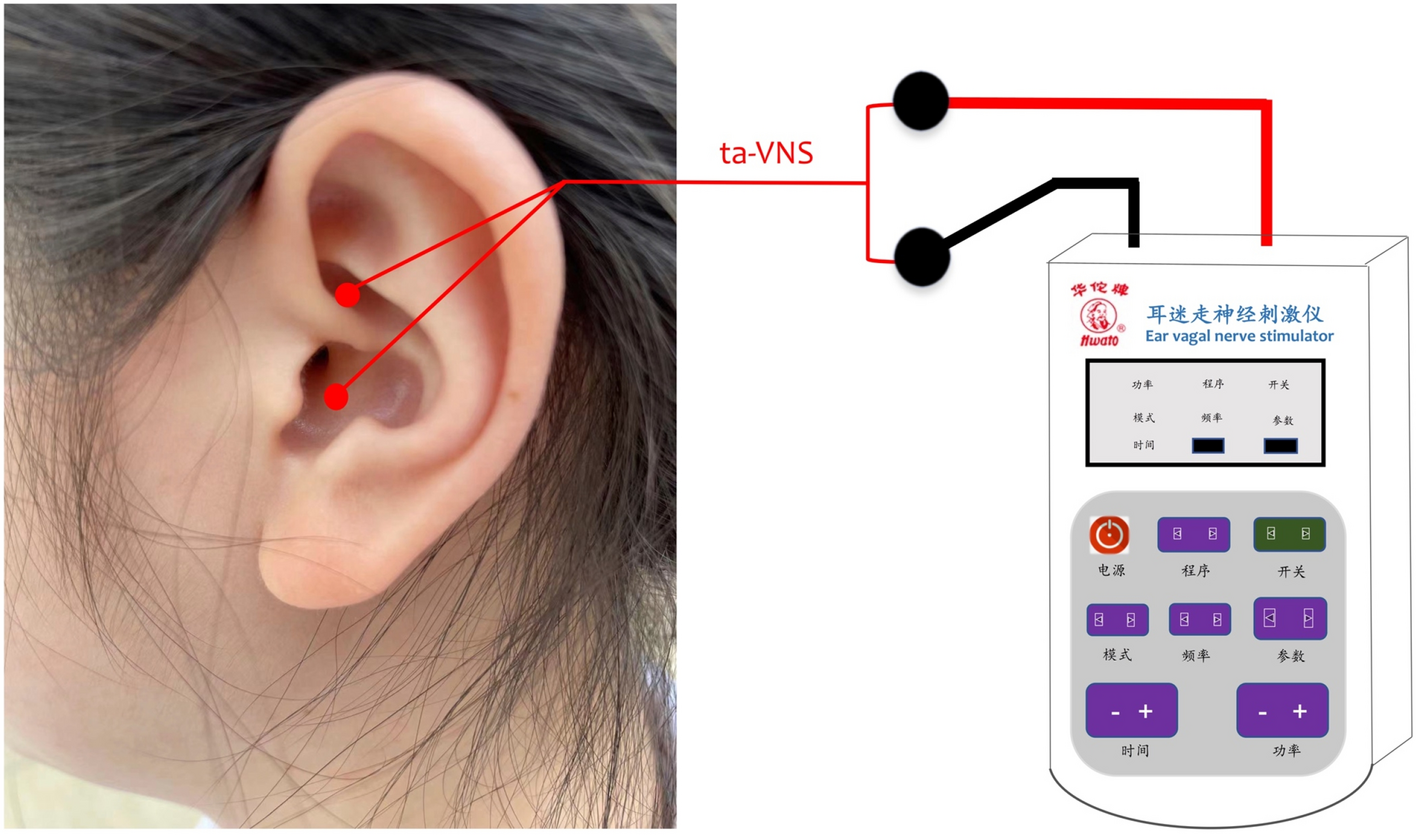 Transcutaneous auricular vagus nerve stimulation as a potential