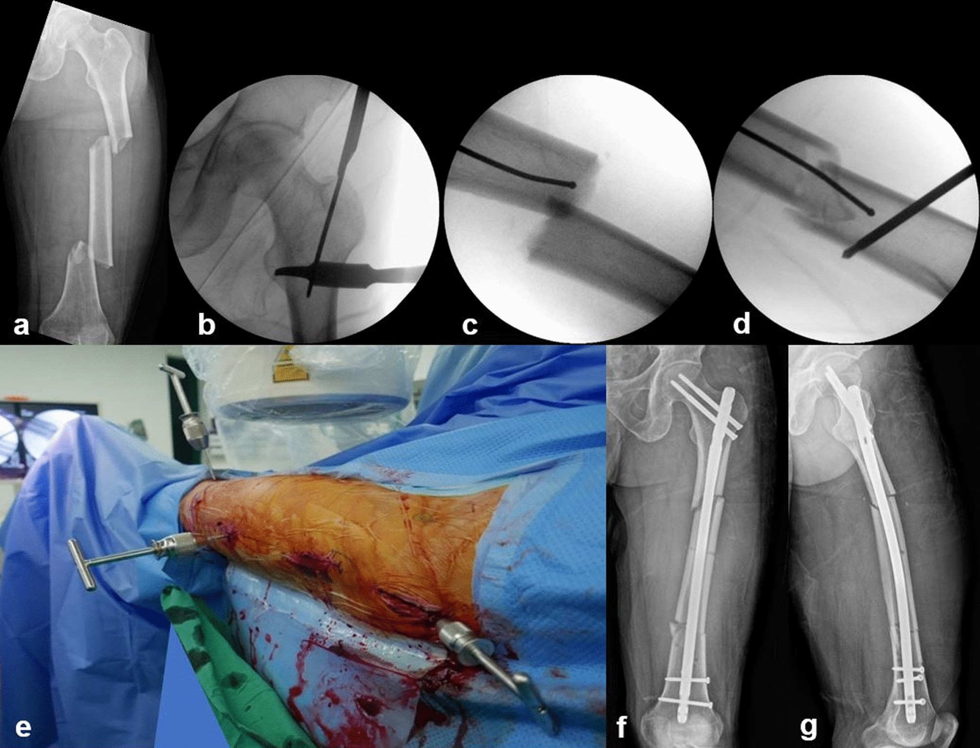Distal femoral fine wire traction assisted retrograde nailing of the femur  | European Journal of Orthopaedic Surgery & Traumatology