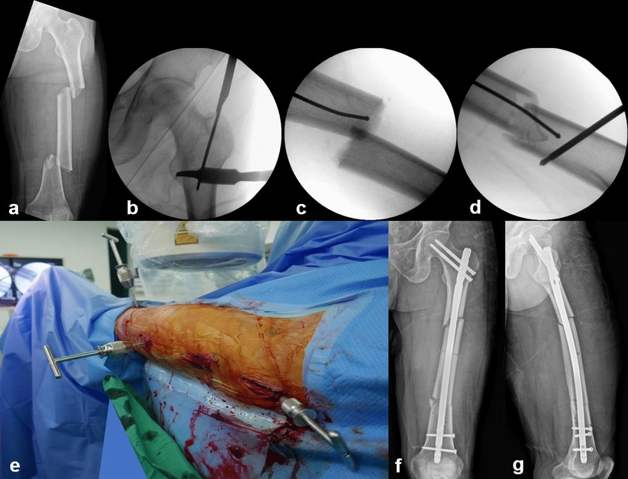 A 46-year-old female with secondary malalignment. The patient did not... |  Download Scientific Diagram