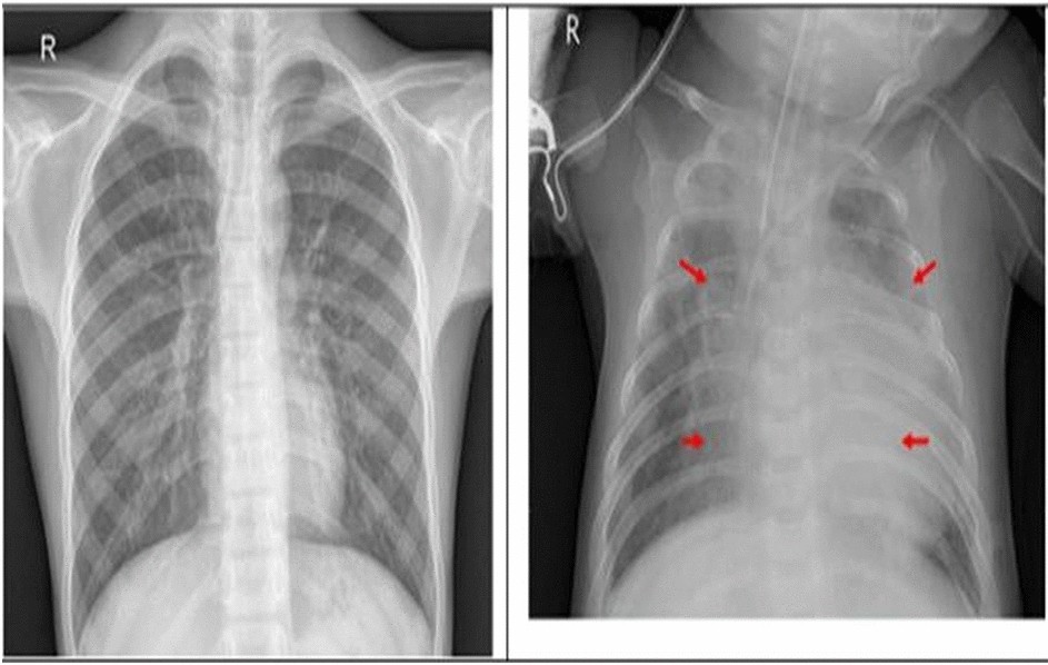 Pneumonia detection with QCSA network on chest X-ray | Scientific Reports