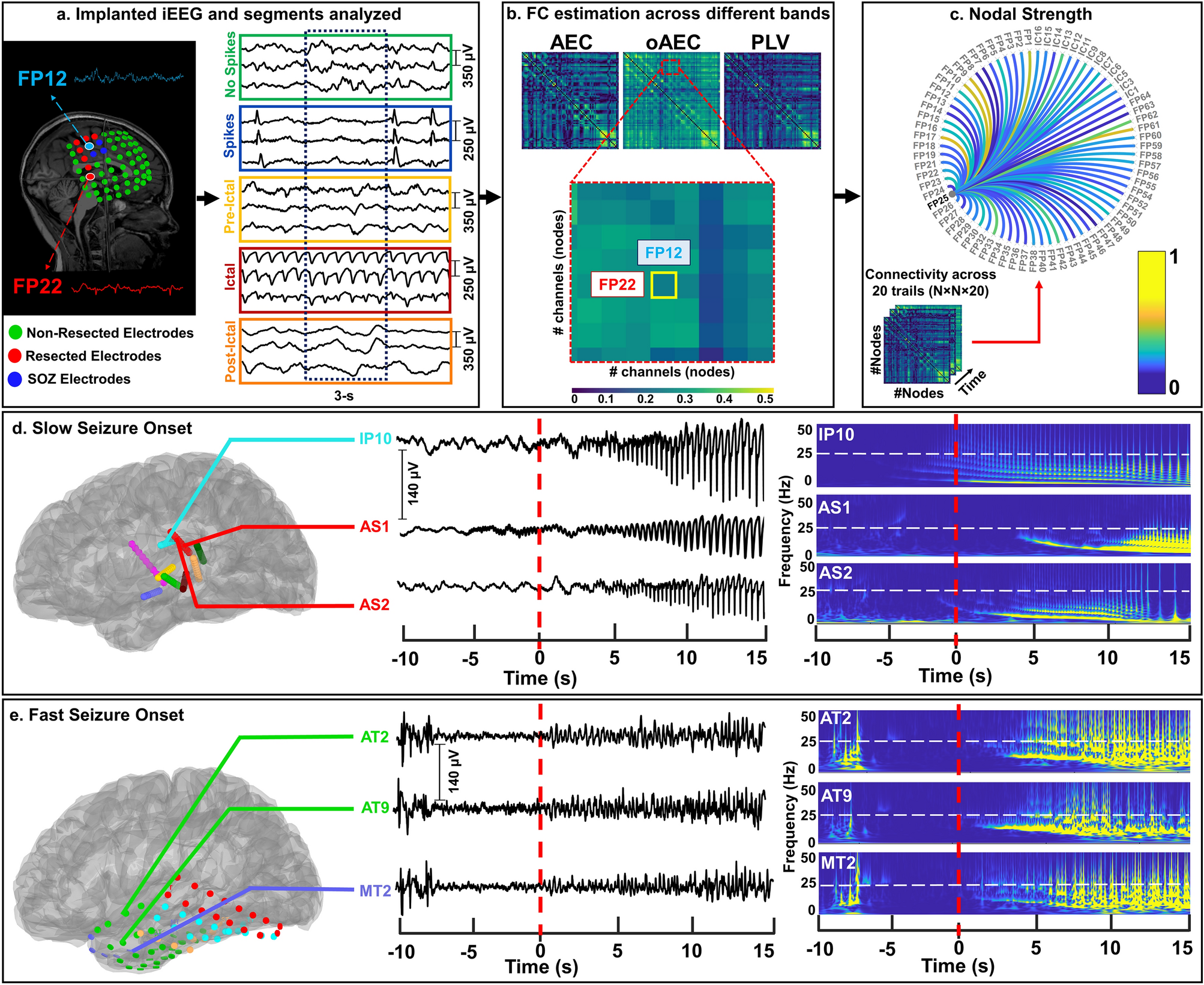 Functional connectivity discriminates epileptogenic states and predicts  surgical outcome in children with drug resistant epilepsy | Scientific  Reports