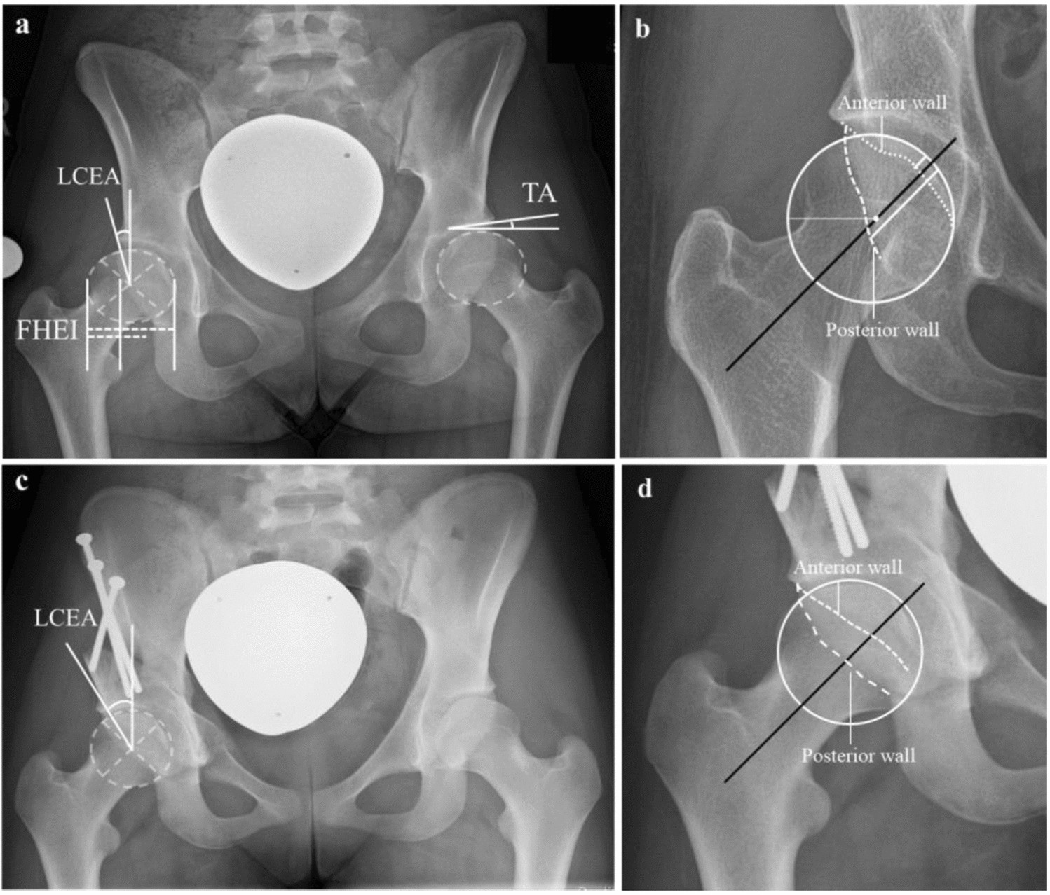 The influence of lumbo-sacral transitional vertebrae in