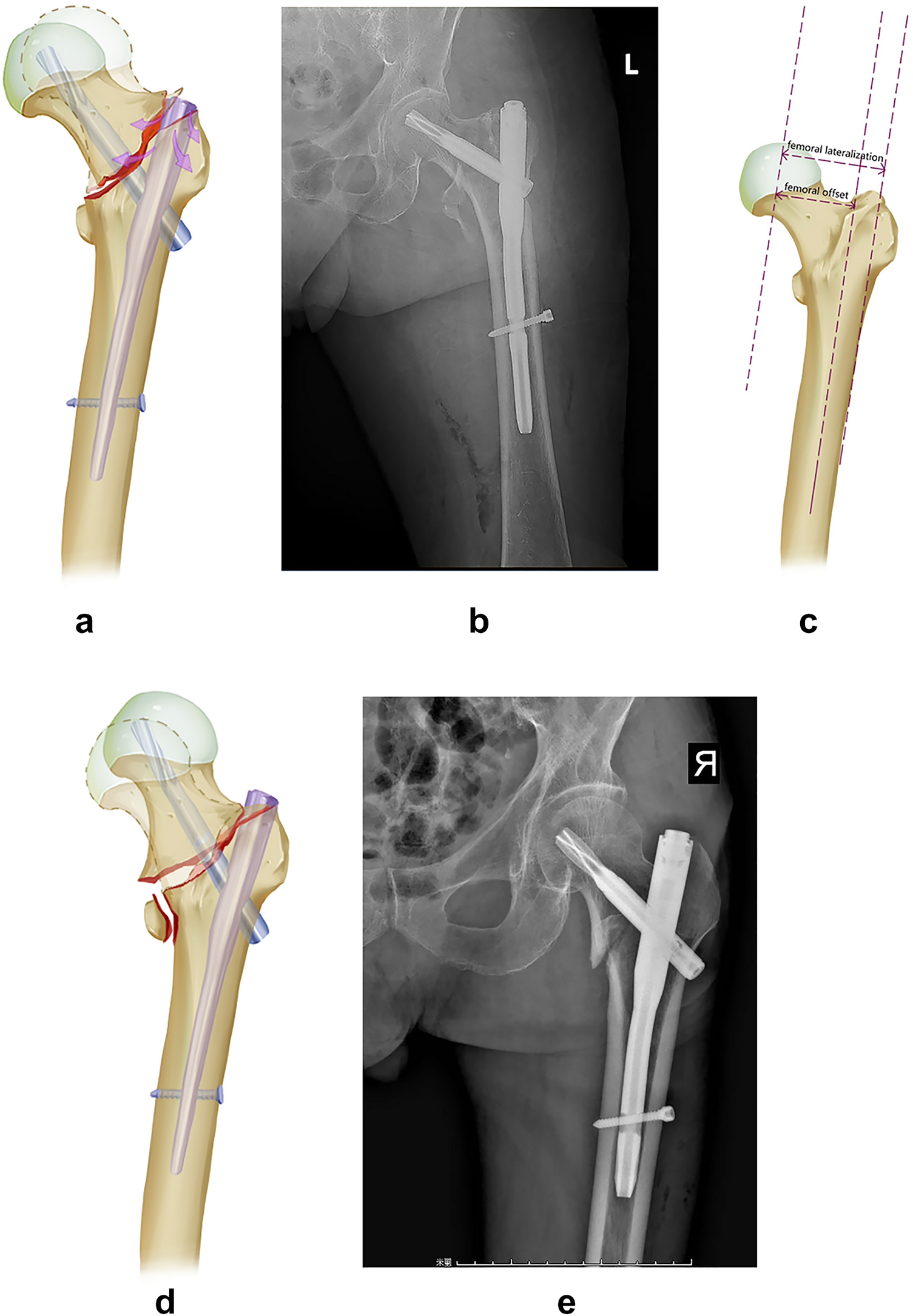 Treatment Strategies for Nonunion After Intramedullary Nailing for Femoral  Fracture: Experiences of Fifty Nonunion Patients