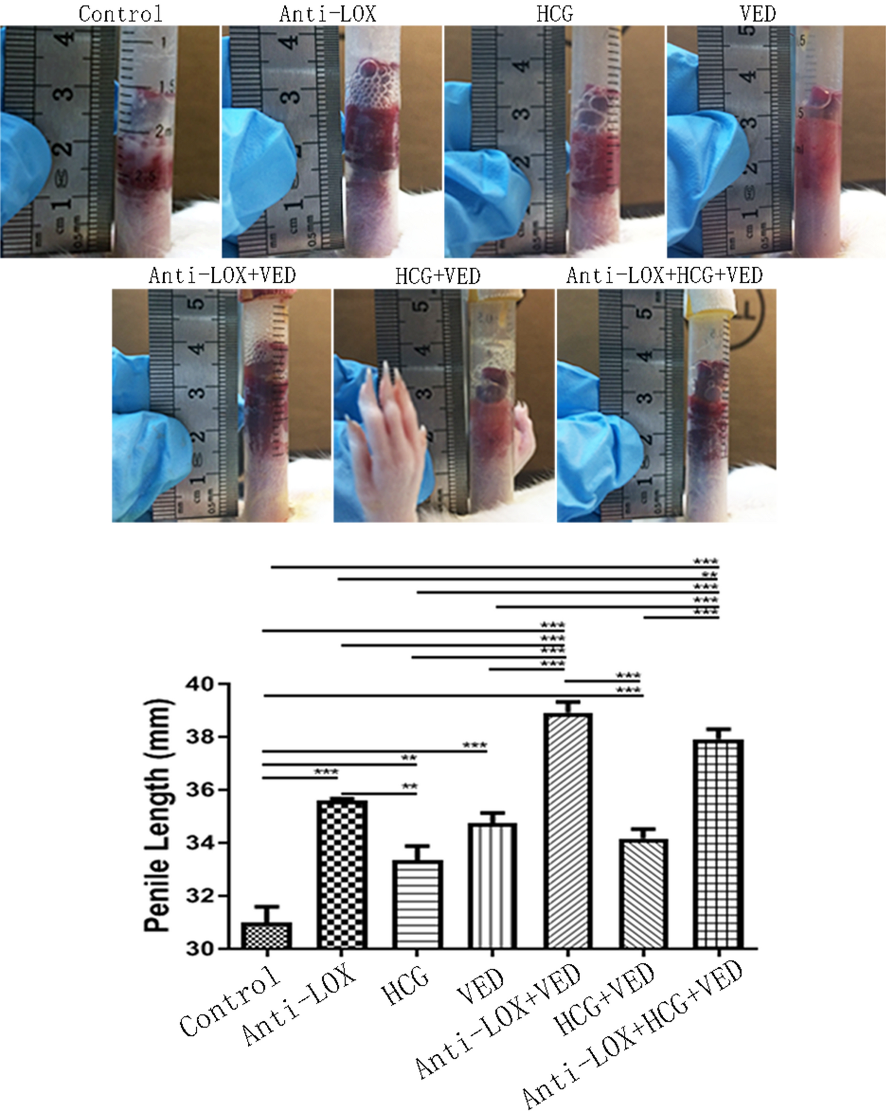 Increase apparent penile length by cryolipolysis in the reduction