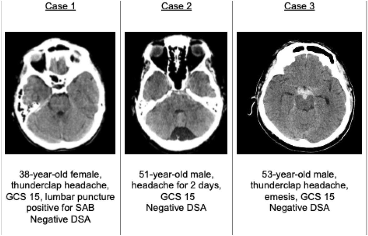 Subarachnoid Hemorrhage Symptoms & Treatment