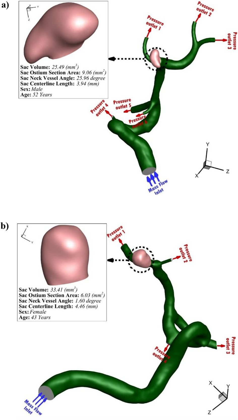 Analysis of the effects of stent-induced deformation on the hemodynamics of  MCA aneurysms | Scientific Reports