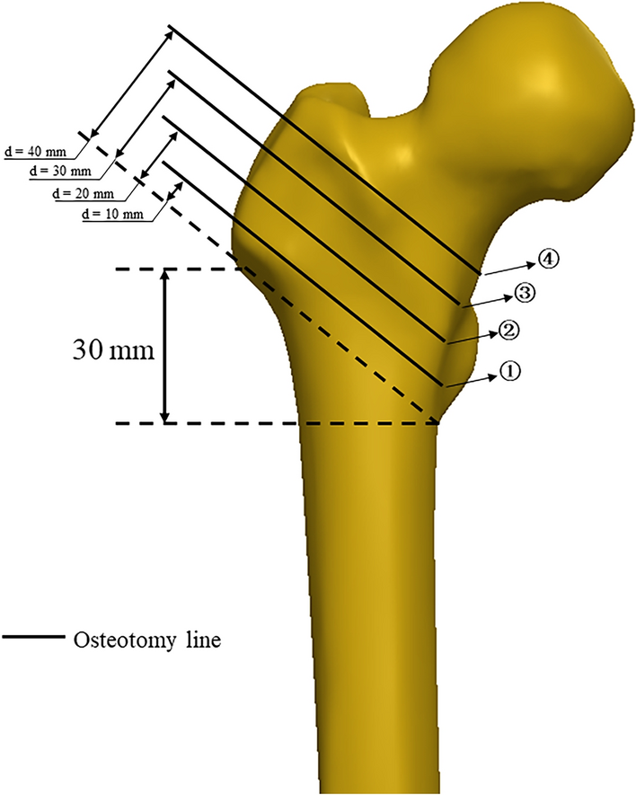 Controlled study on Gamma nail and proximal femoral locking plate for  unstable intertrochanteric femoral fractures with broken lateral wall |  Scientific Reports