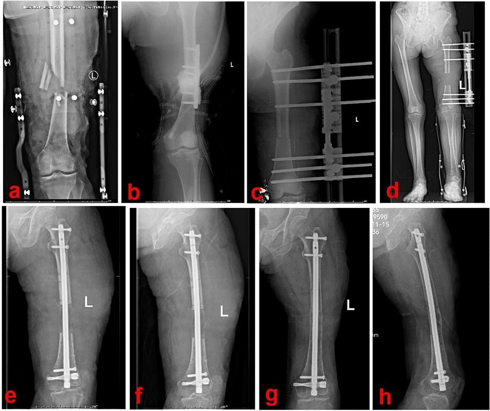 Comparing outcomes of plate augmentation, nail exchange, and nail exchange  with plate augmentation in the treatment of atrophic femoral shaft nonunion after  intramedullary nailing: a multicenter retrospective study | Archives of  Orthopaedic