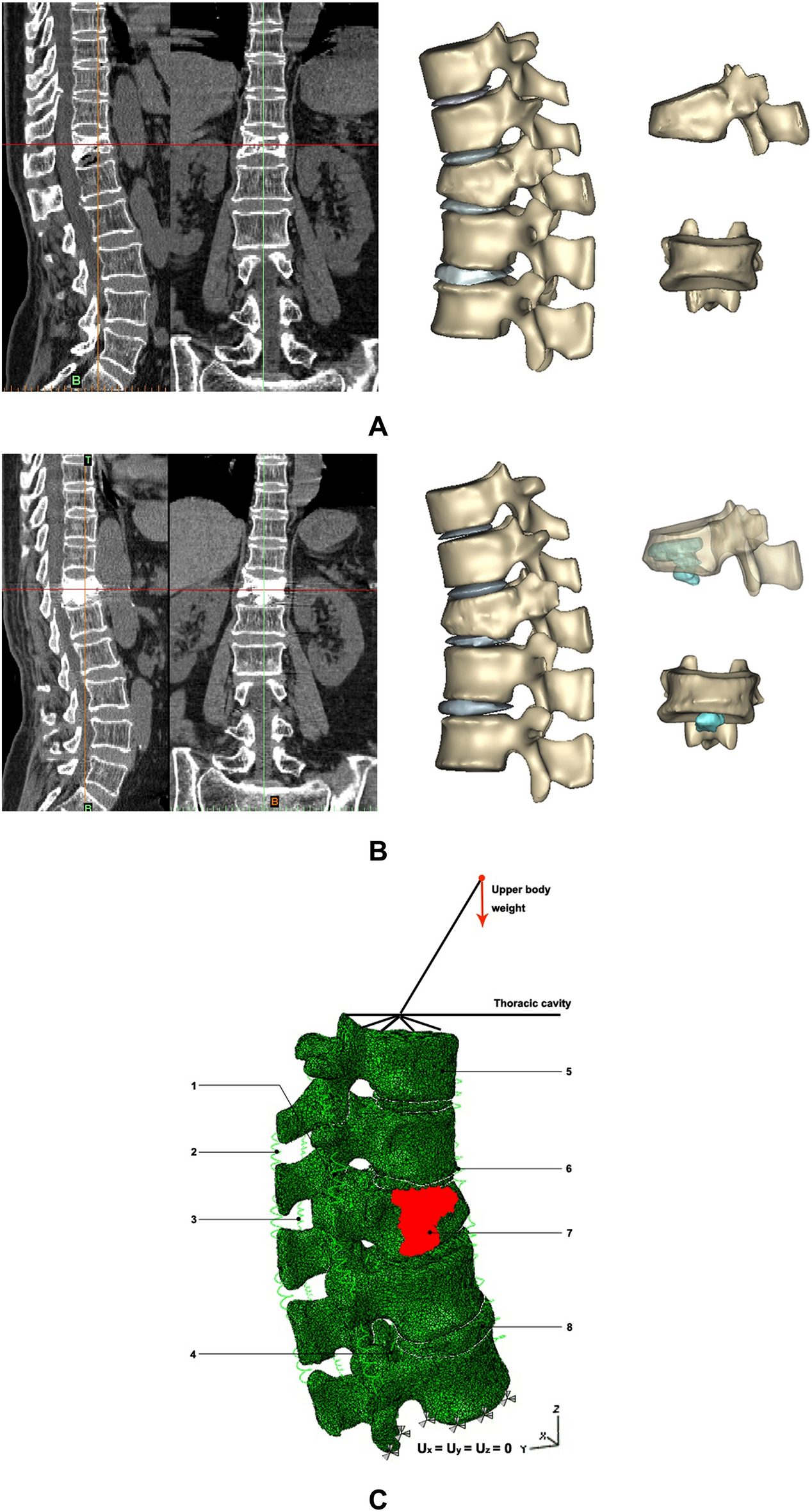 Intradiscal cement leakage (ICL) increases the stress on adjacent vertebrae  after kyphoplasty for osteoporotic vertebra compression fracture (OVCF): a  finite-element study | Scientific Reports