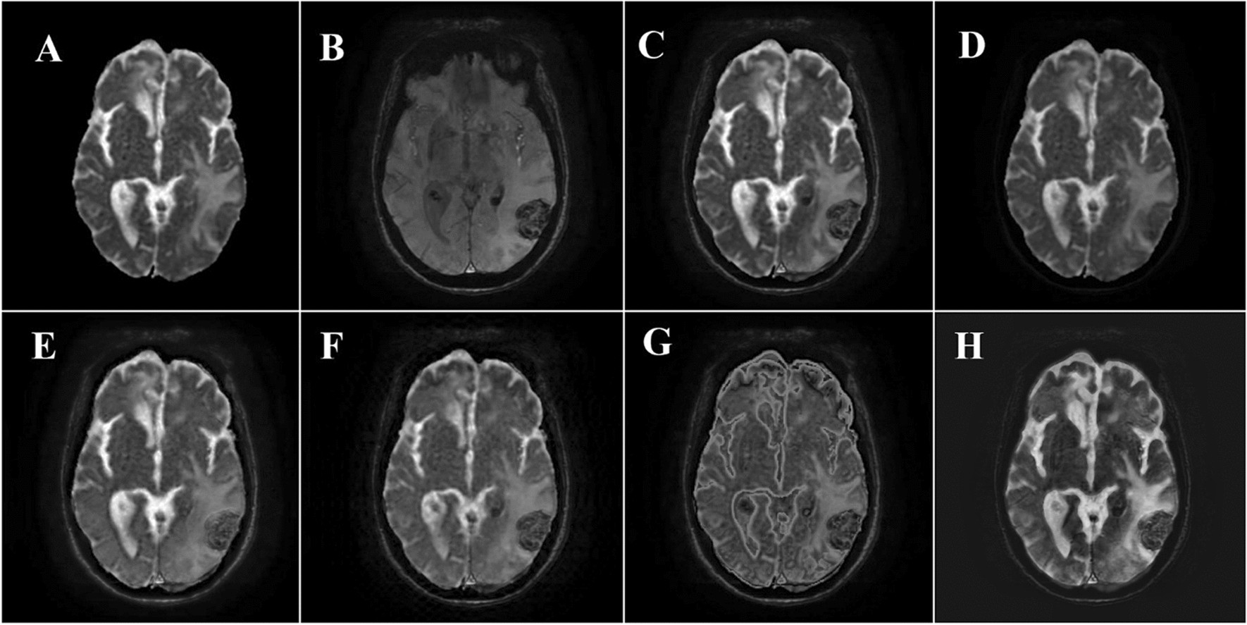 Performance comparison of different medical image fusion algorithms for  clinical glioma grade classification with advanced magnetic resonance  imaging (MRI) | Scientific Reports