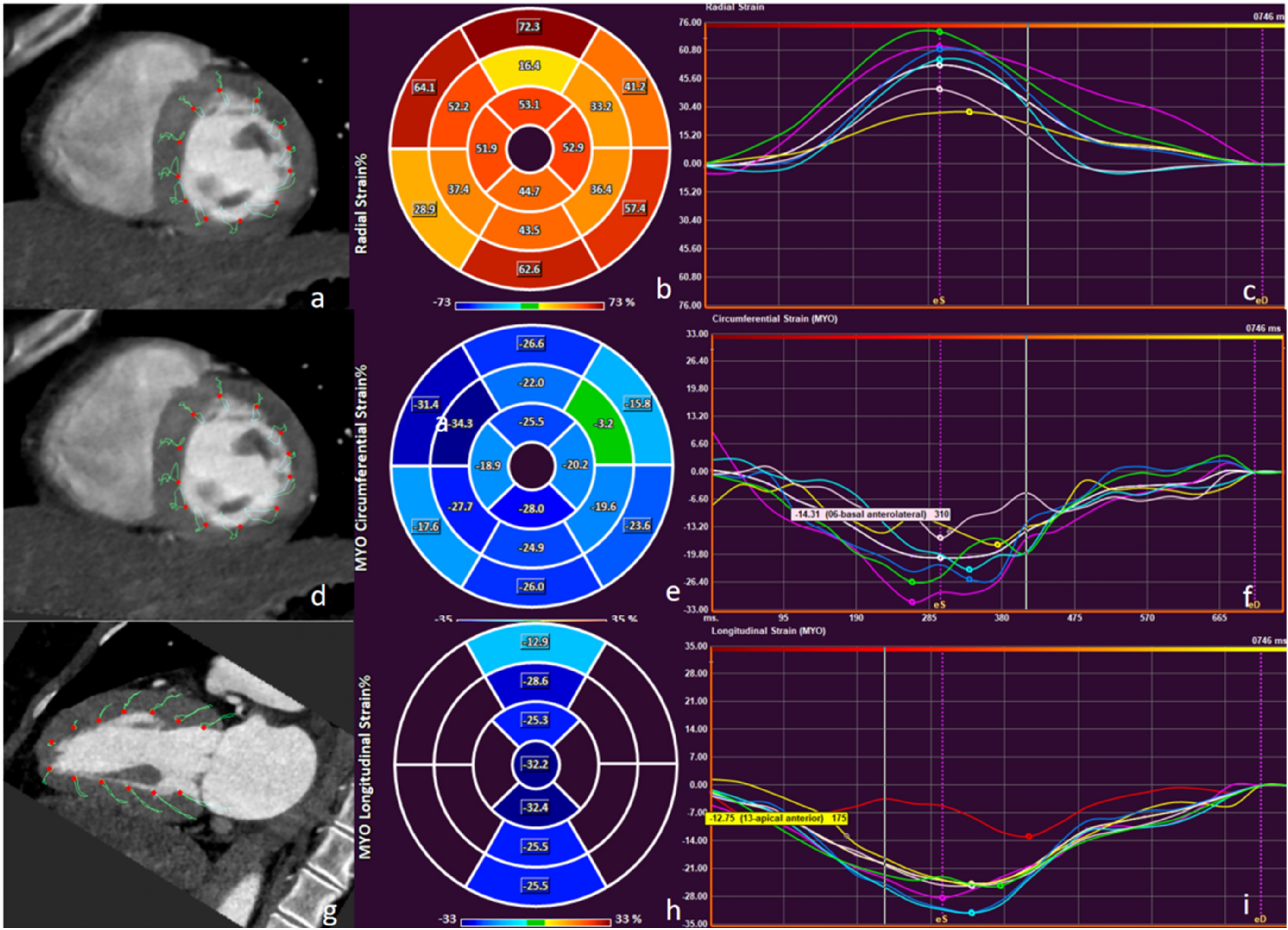 Myocardial strain to detect subtle left ventricular systolic