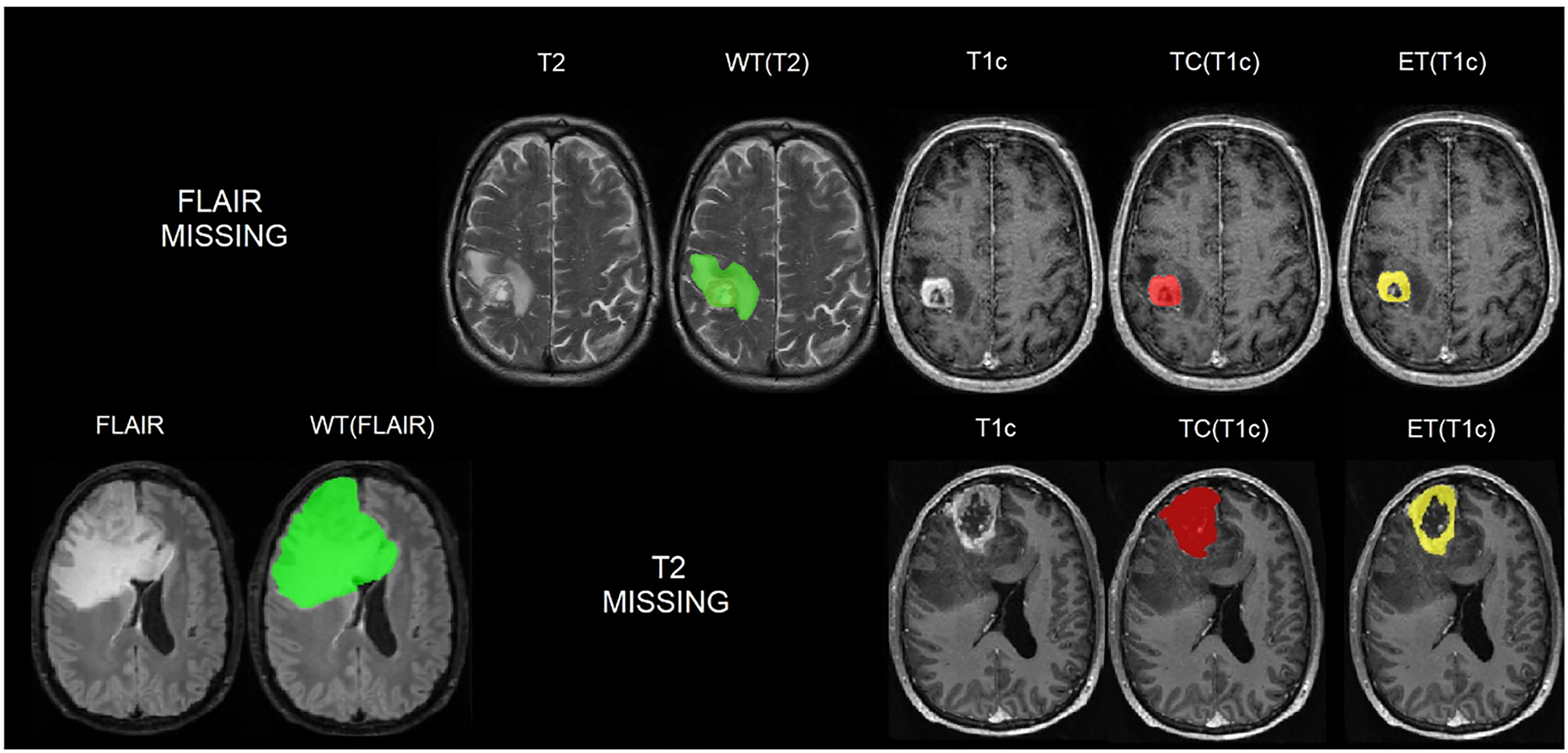Multi-class glioma segmentation on real-world data with missing 