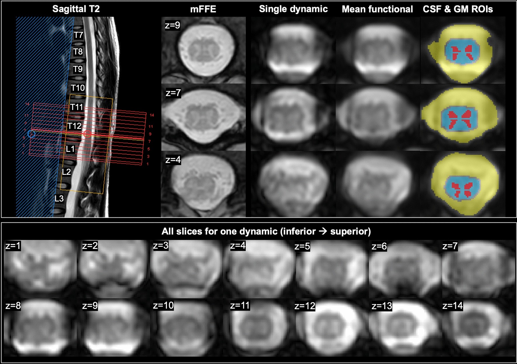 Detection of resting-state functional connectivity in the lumbar spinal  cord with 3T MRI