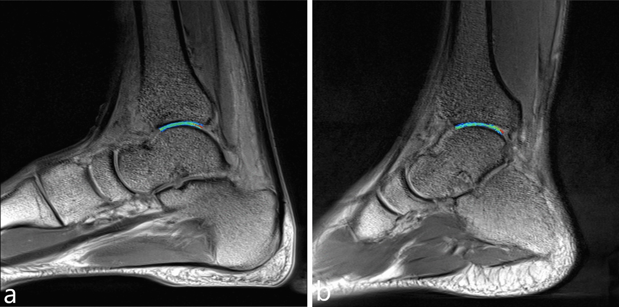 T2 mapping for quantitative assessment of ankle cartilage of weightlifters  | Scientific Reports